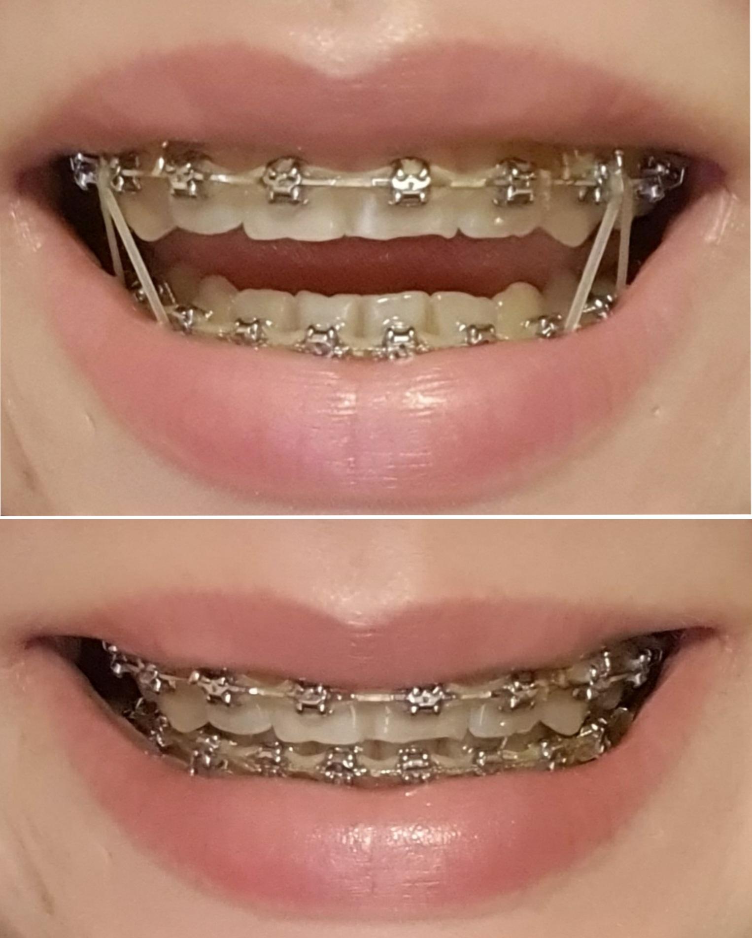 Braces off in two weeks should I get composite bonding or leave them