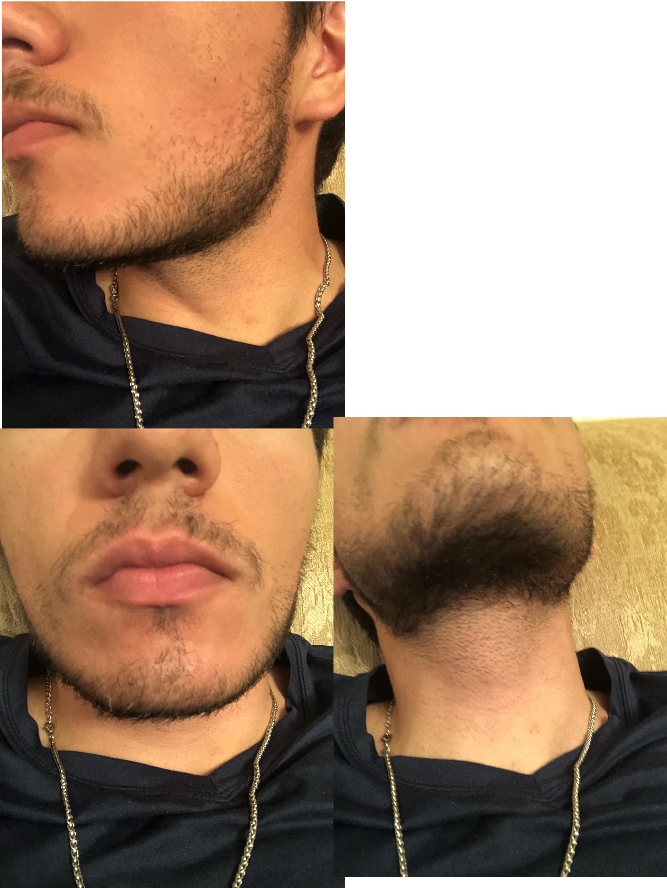 12 days in..Started growing some velus hairs on cheeks. How long would