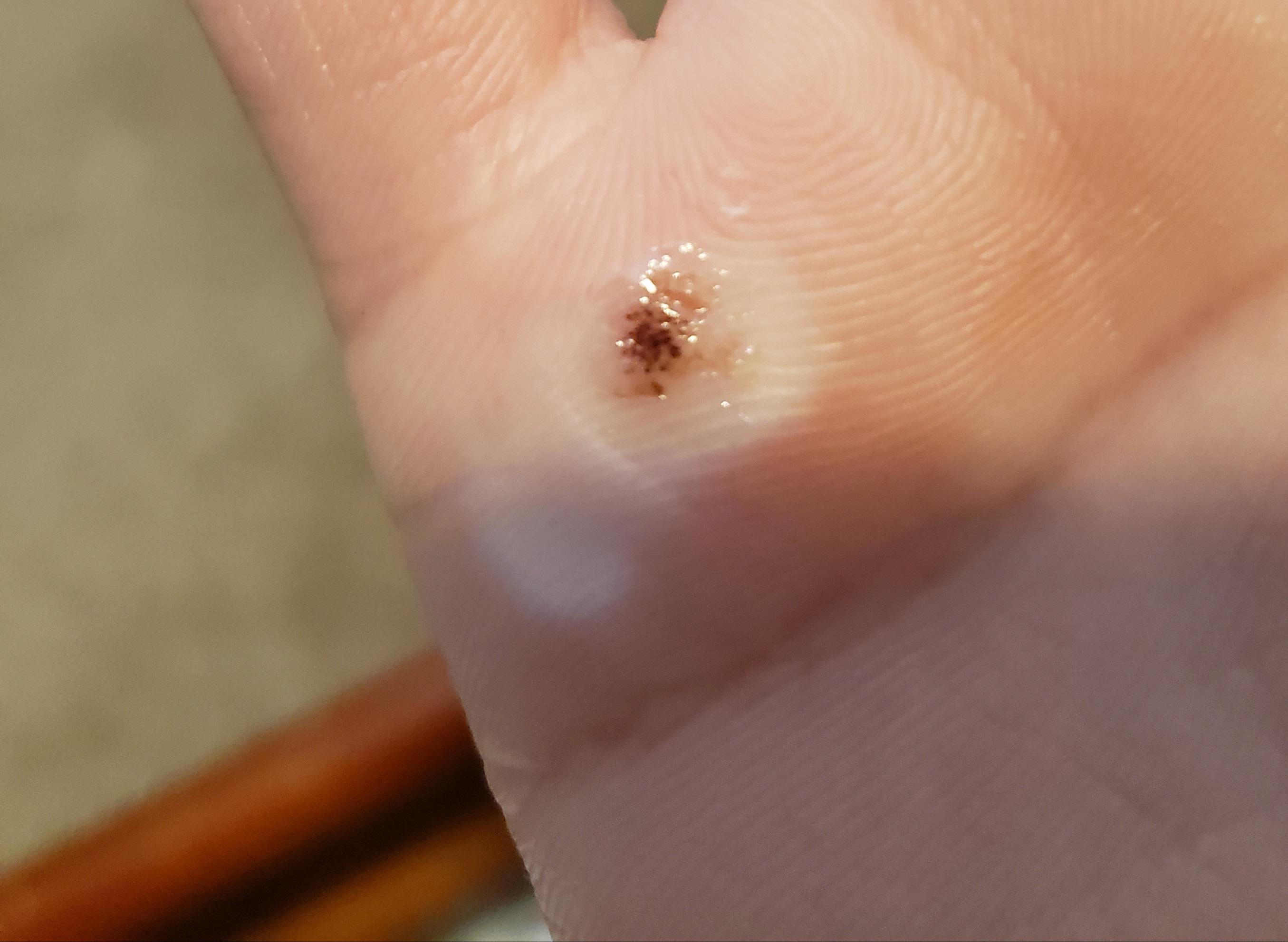 Is the wart dying? Any suggest to remove warts at home? Big thanks😭 r/Warts