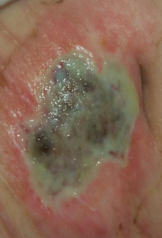 I have this burn does it look infected? It smells really bad and keeps