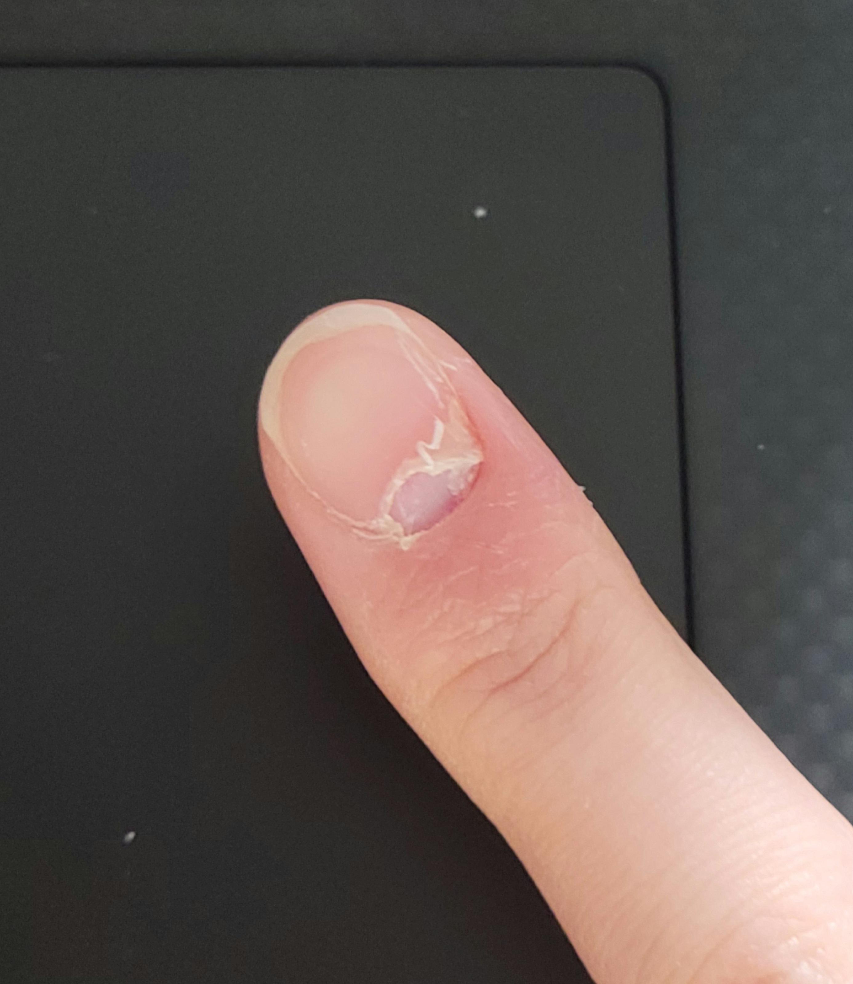 Thanks, I hate when my nail comes off the wrong way r/TIHI