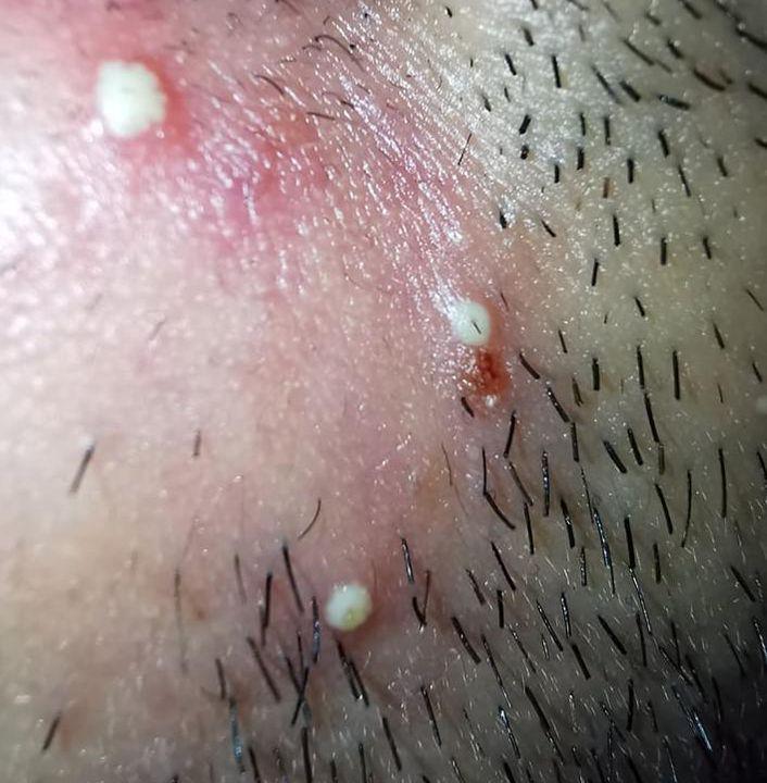 Severe oily skin with a lot of pustules. How can i treat my oily skin