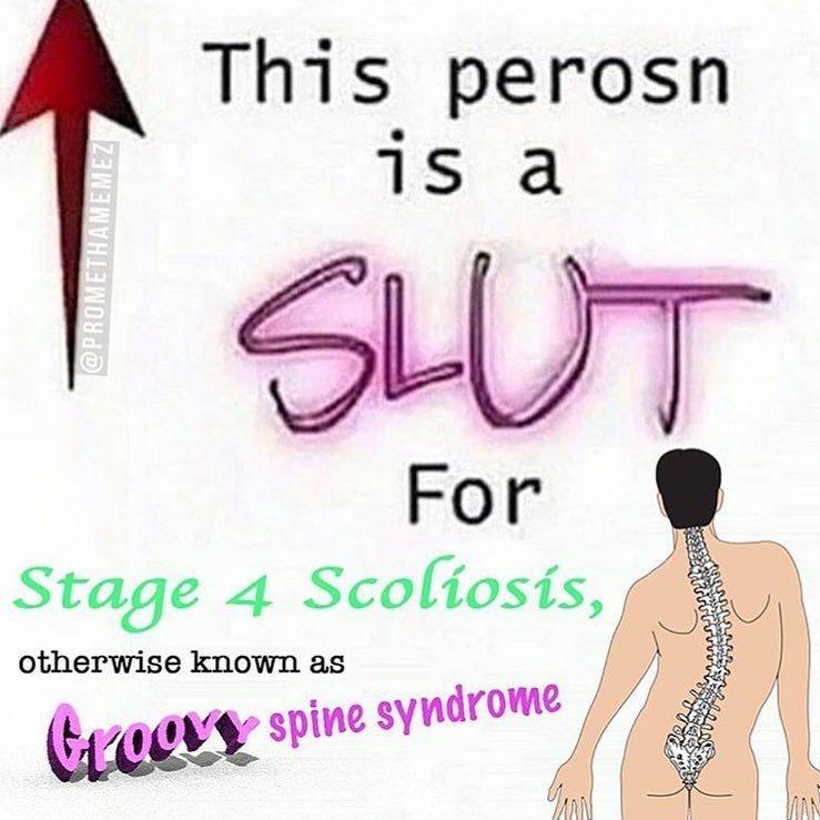 I have scoliosis but not that bad. r/teenagers