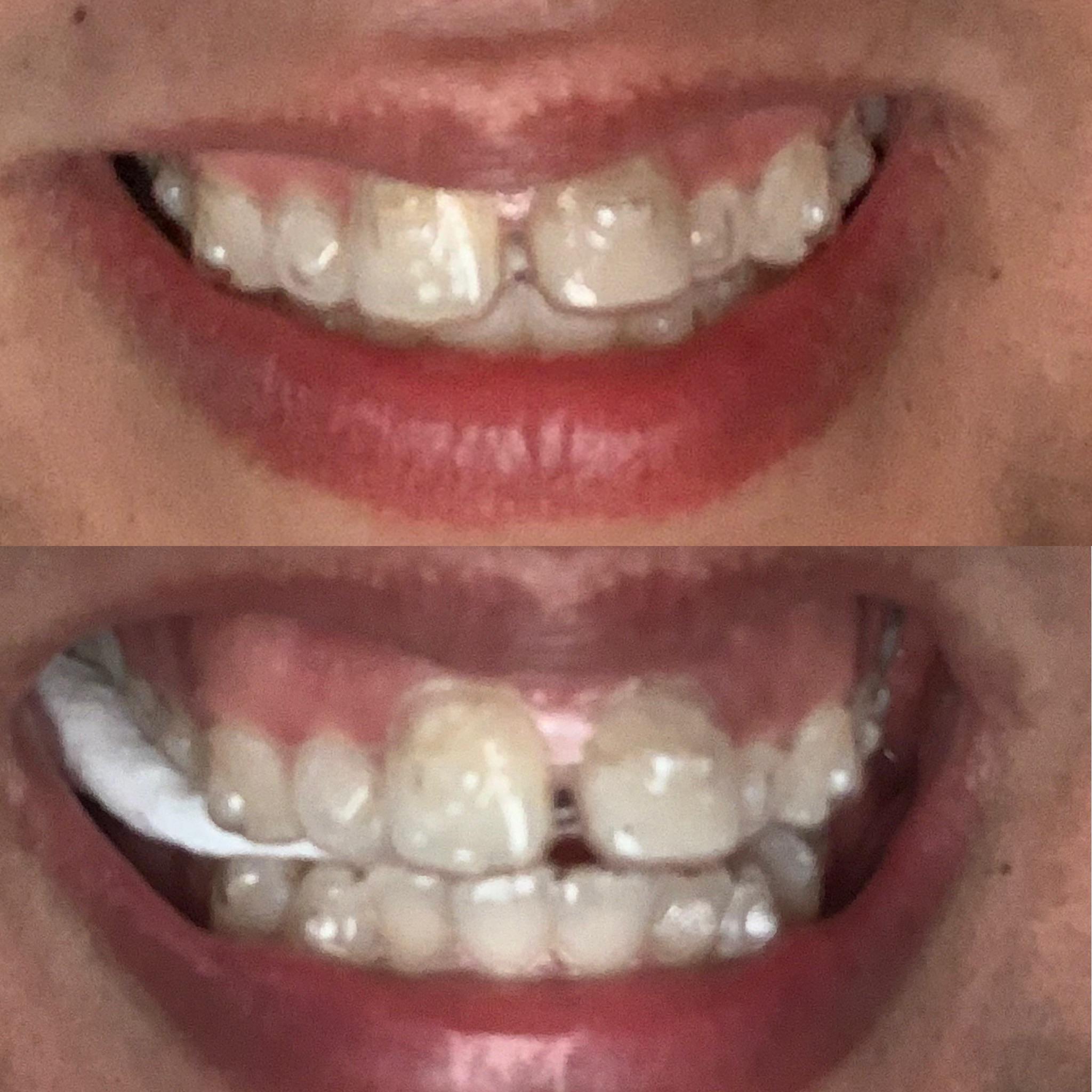 How Often Do You Need to Switch Out Your Invisalign.