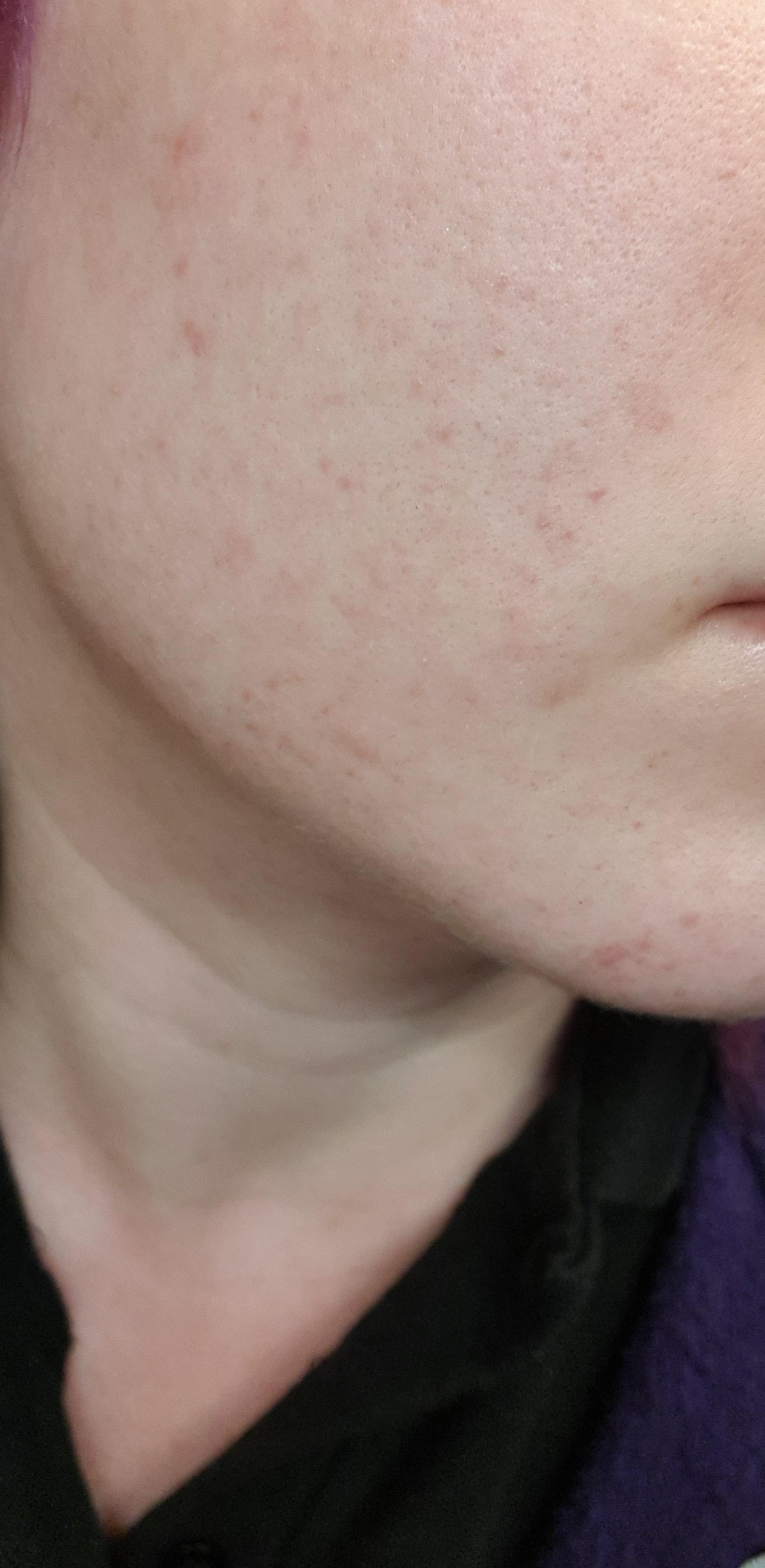 Rash across lower half of my face immediately after vomiting. Happens pretty much every time