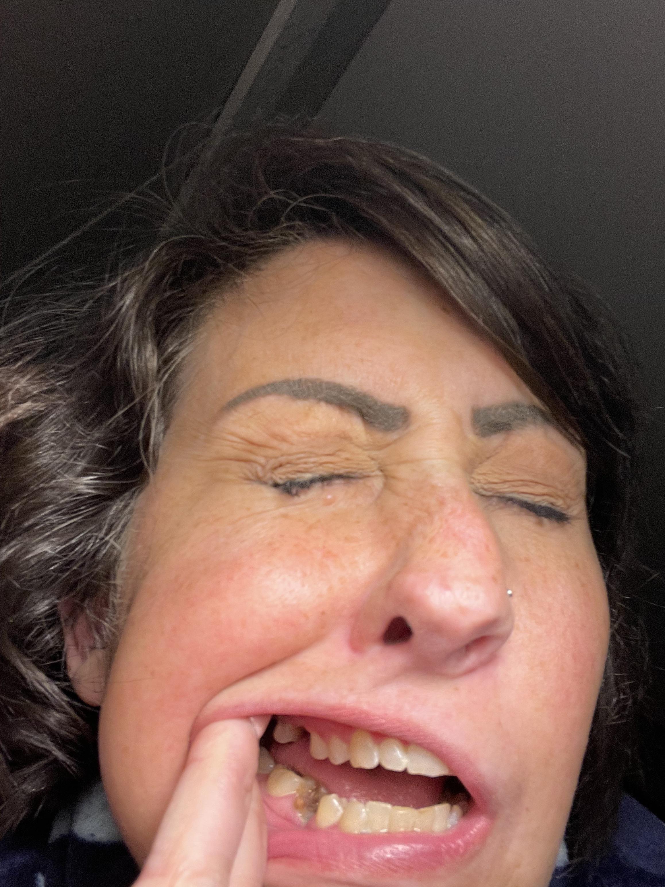 These sore white lines have been bothering me on the roof of my mouth