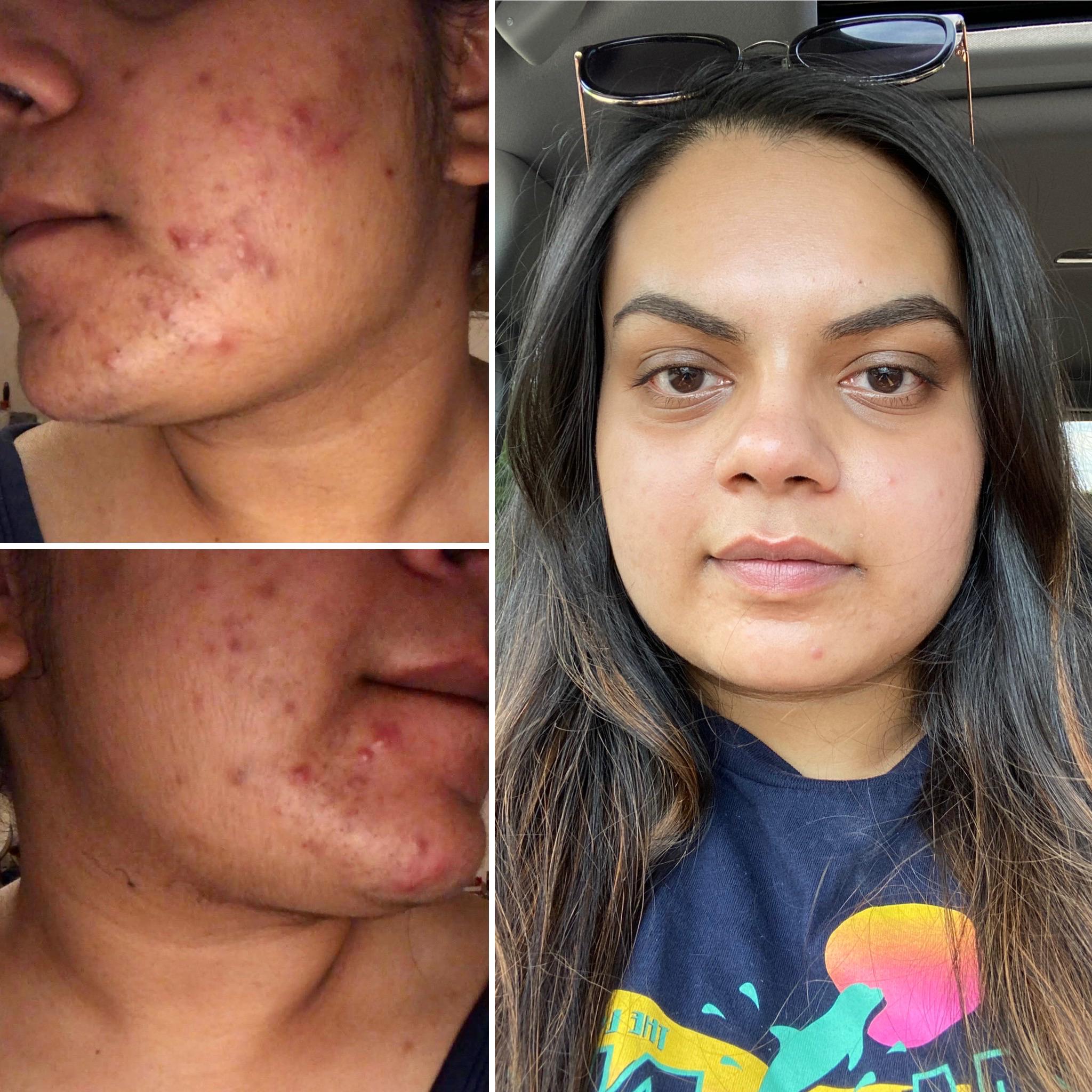 [B&A] My hormonal acne was at its worst a year ago but I’m finally