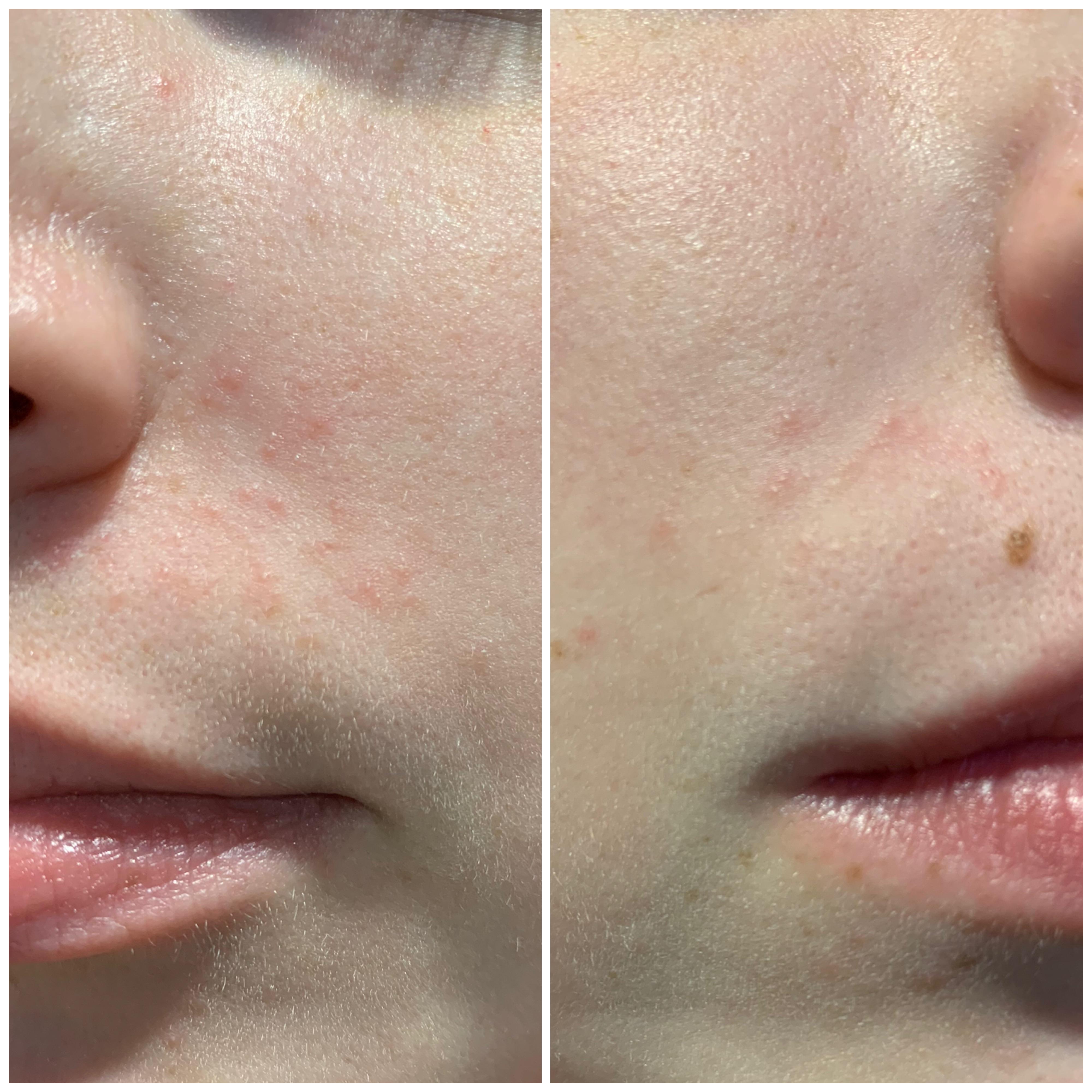 Is this perioral dermatitis? I just finished 6 months on accutane and