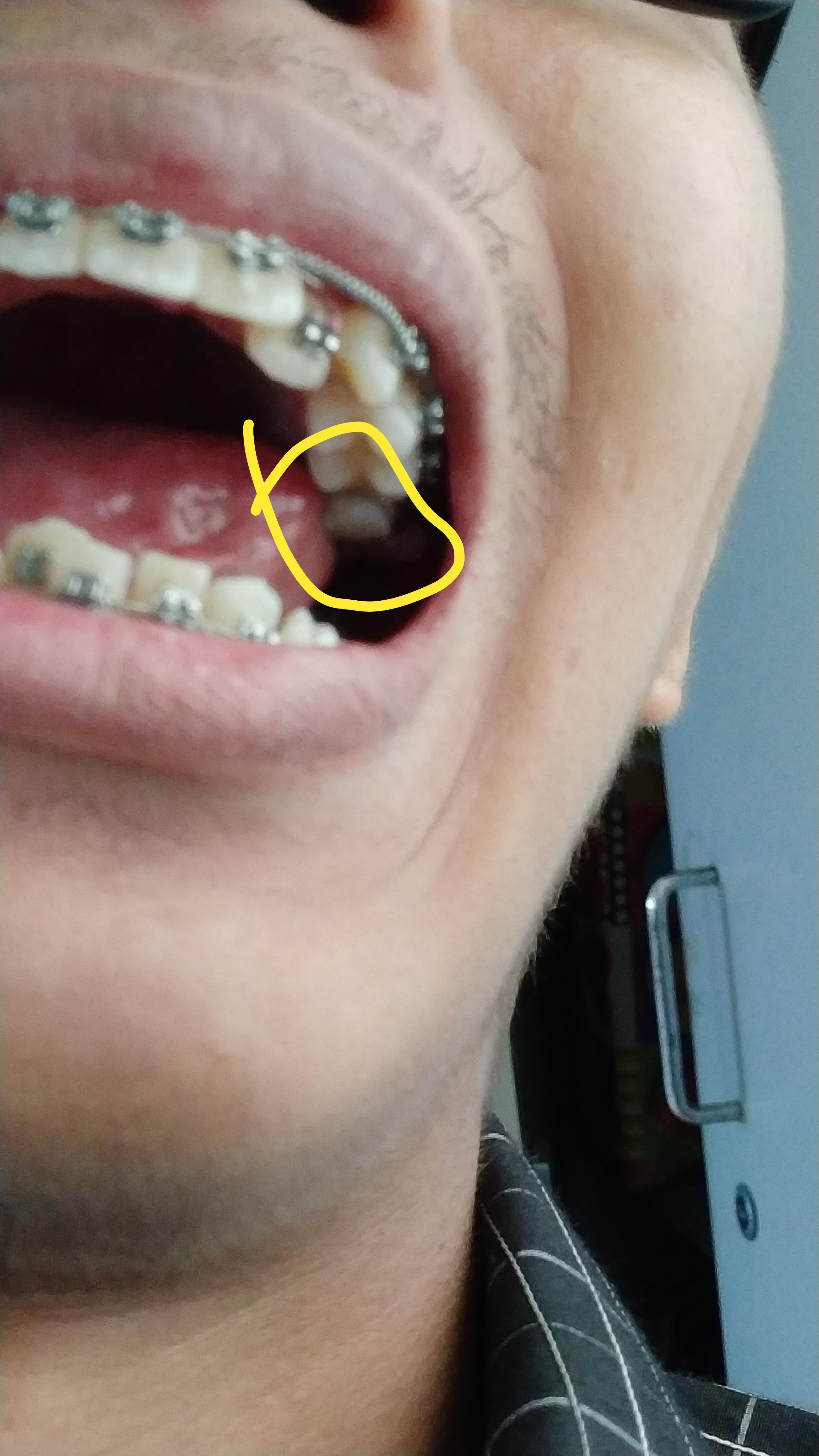 A lump of hard thing is glued to my upper molar tooth. What it is? How