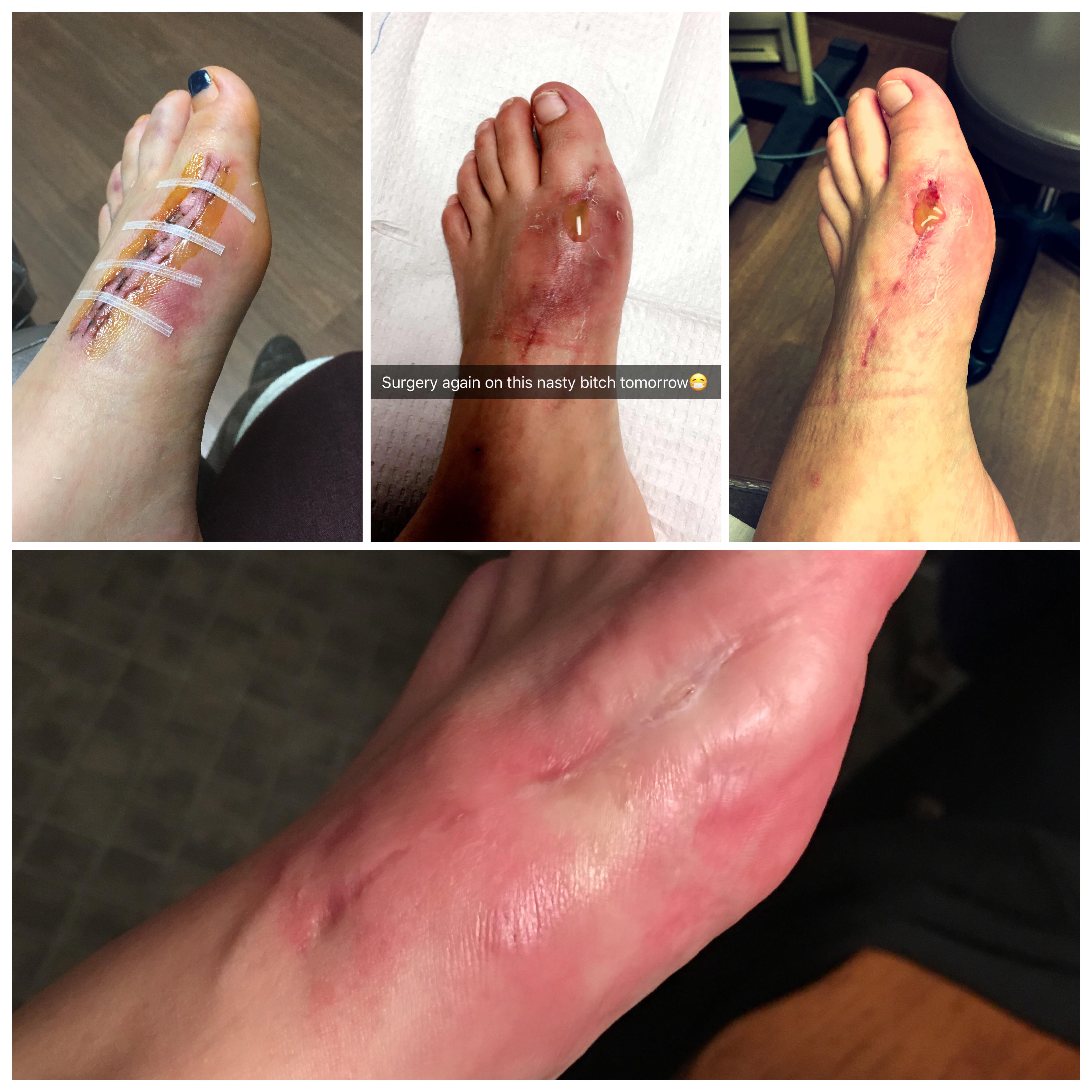 UPDATE Got bad news today. My fourth surgery is scheduled for next