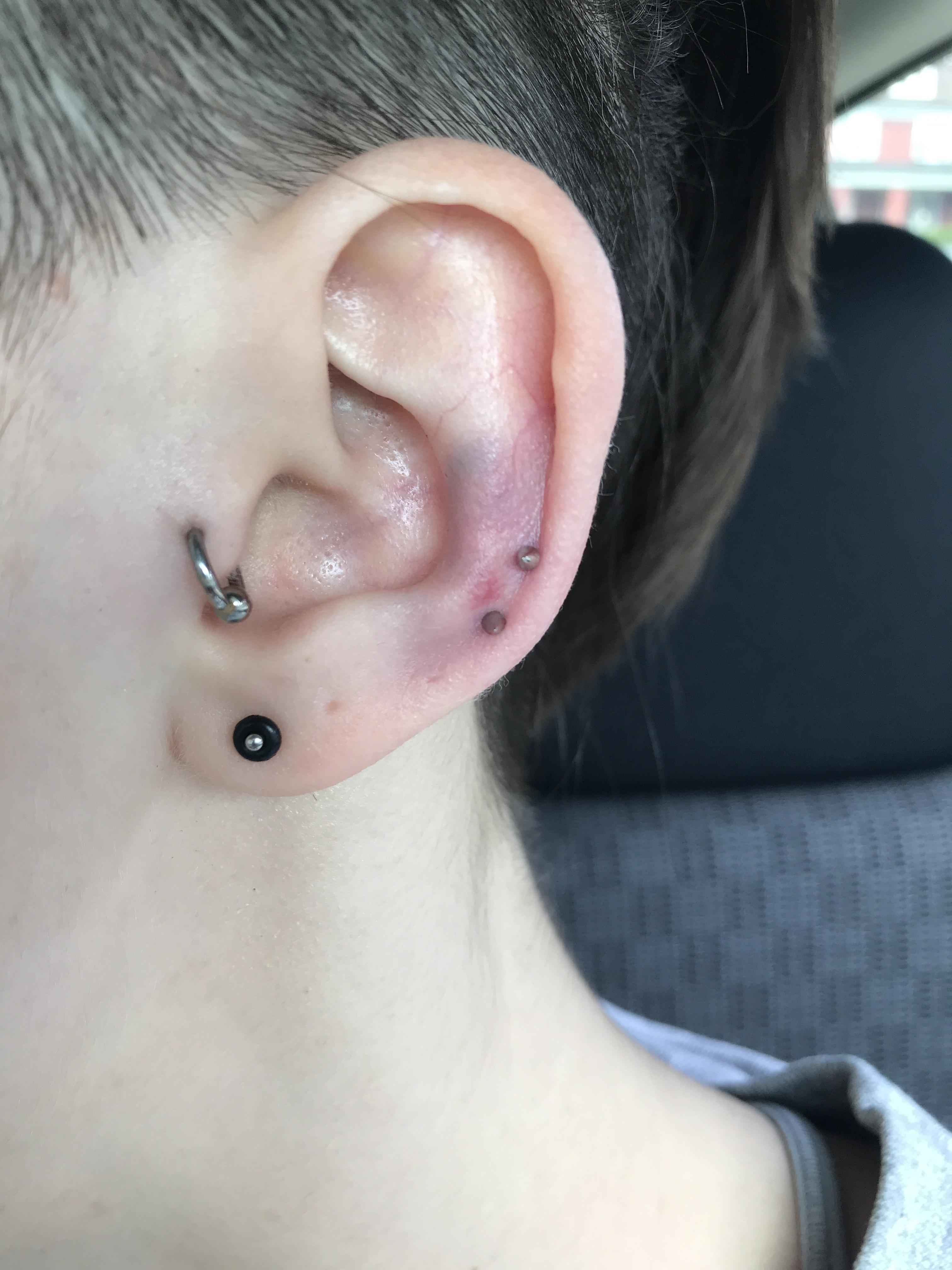 Is bruising like this normal on a double helix? only done yesterday