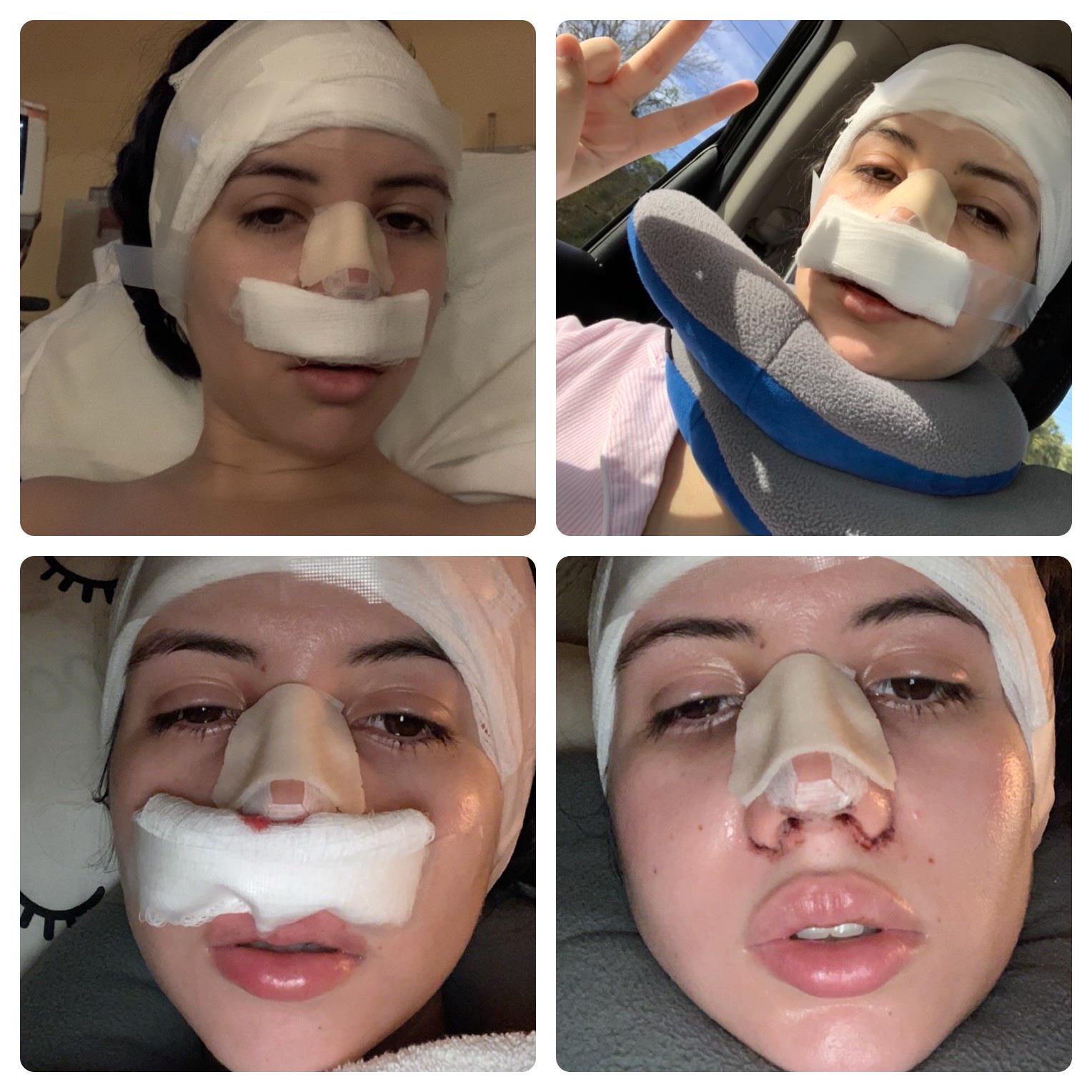 Day of and day after septorhinoplasty with alar reduction and right