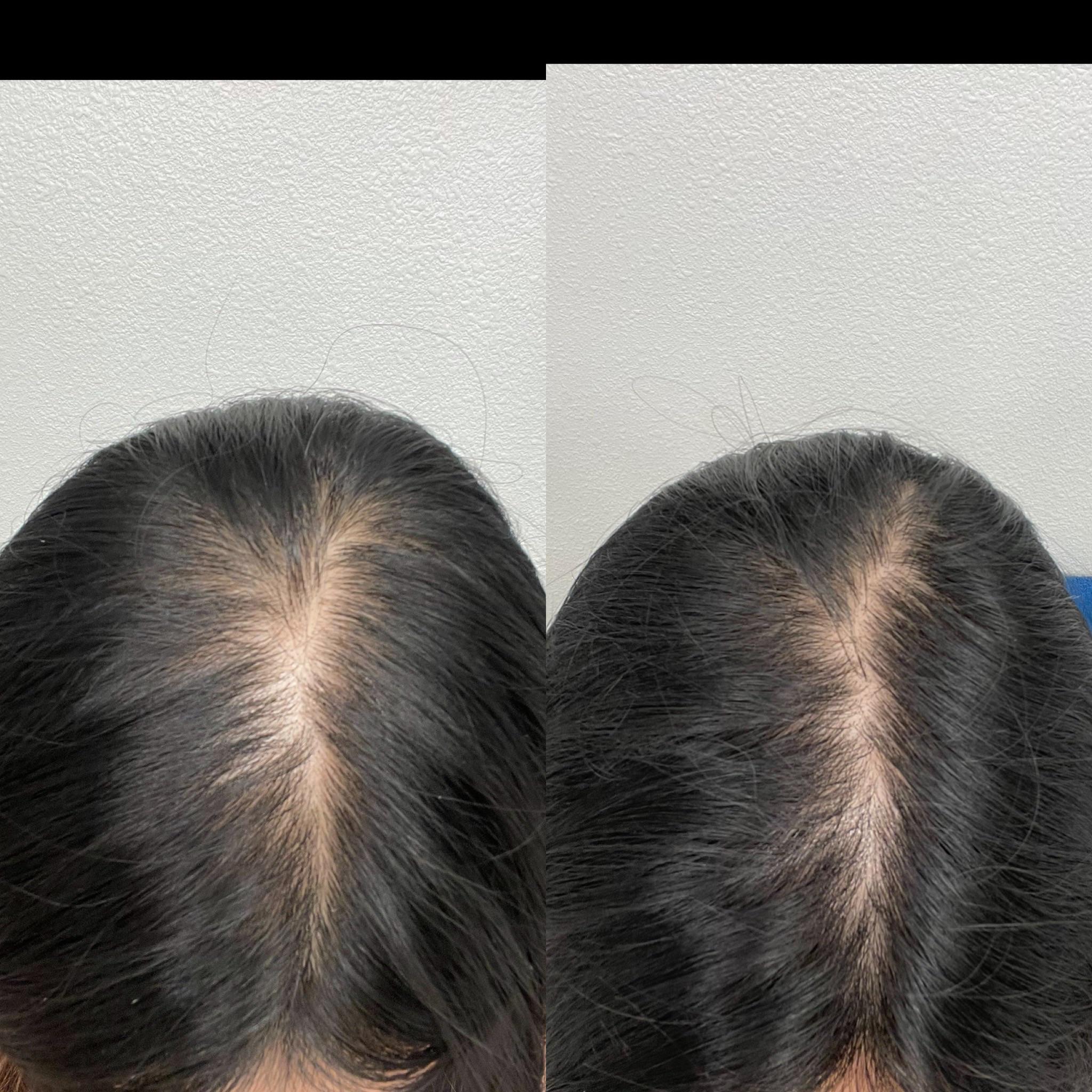 Progress oral min + spiro r/FemaleHairLoss