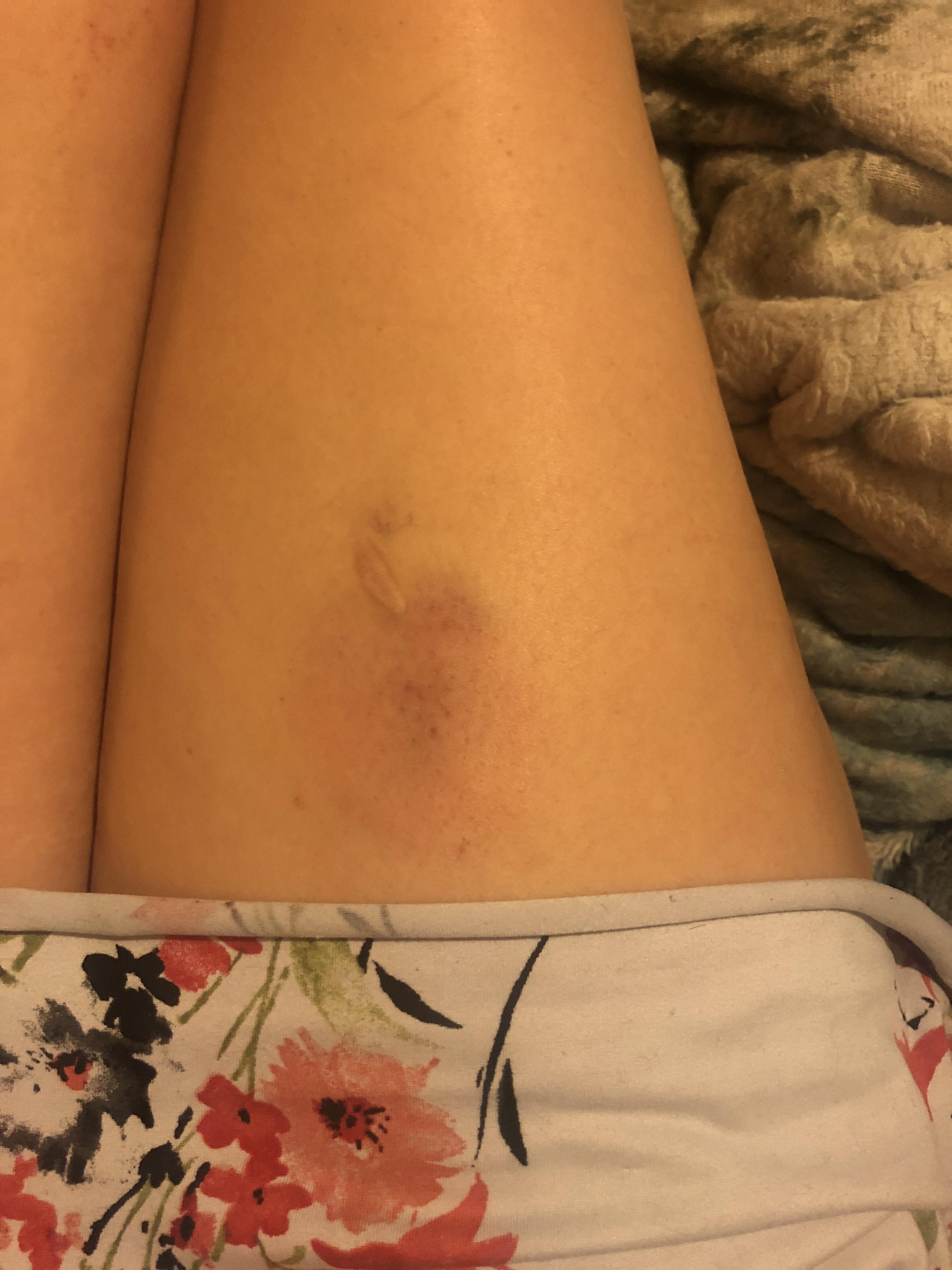 Benlysta leaves bruises and rashes. Sometimes when I take my Benlysta