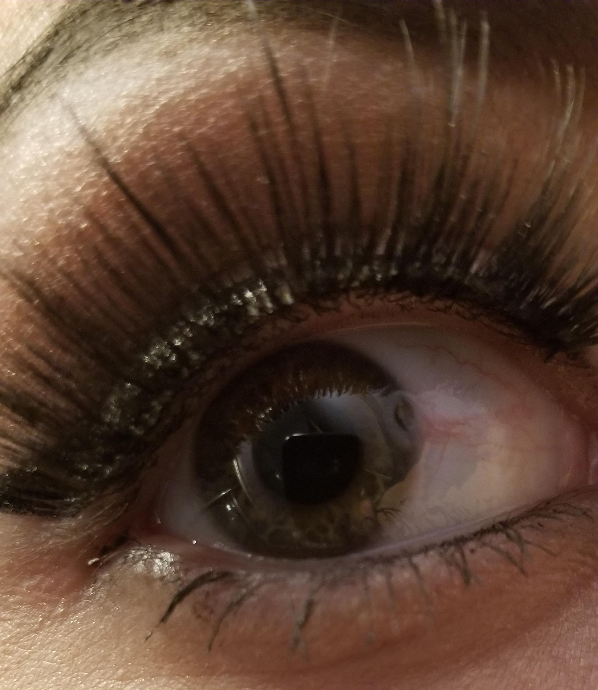 Anyone know what's happening with this dent in my eye? Panicked at