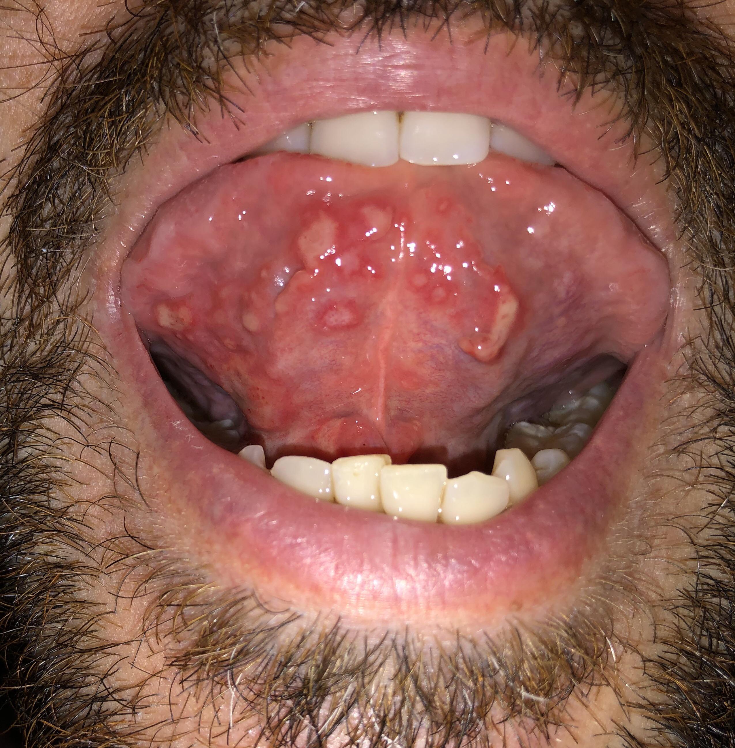 15+ canker sores under my tongue! Why God?!!! CankerSores