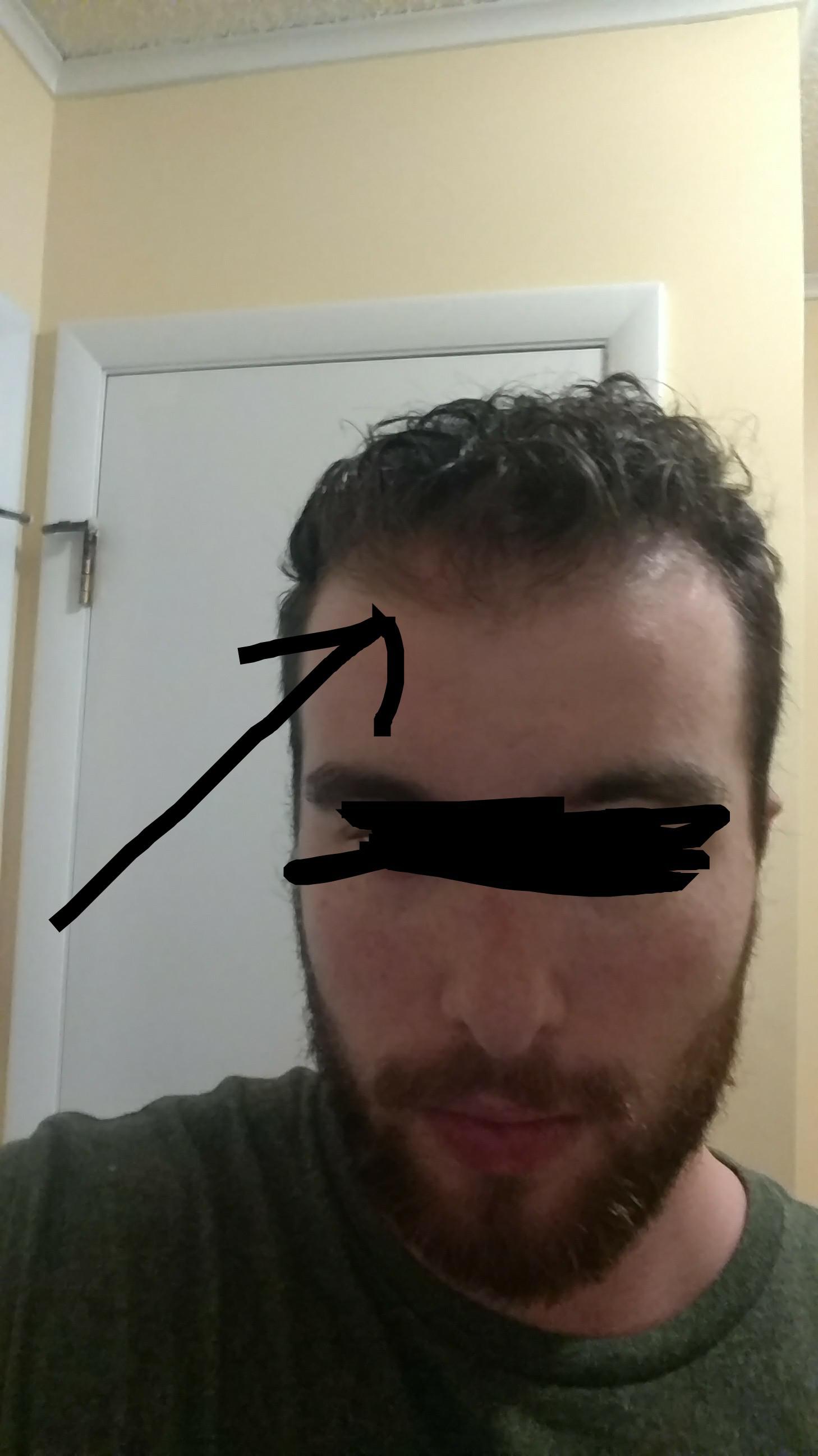 Hair seems to be thinning on widows peak hair advice/ hairstyles would