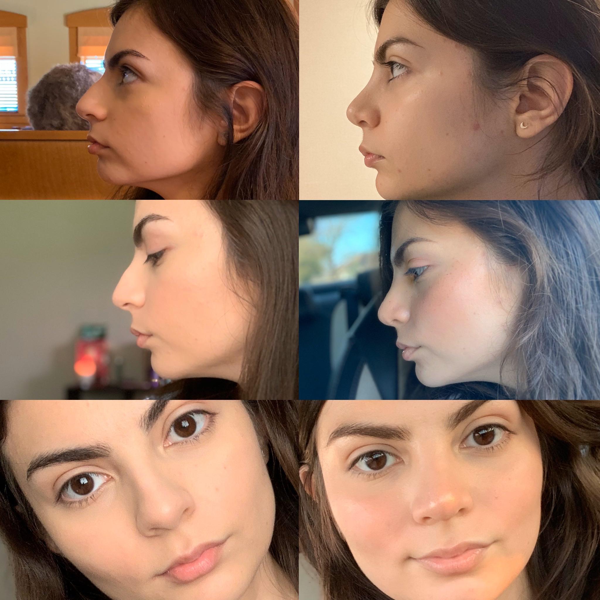Before and After Rhinoplasty!! I’m so obsessed; I take pictures of it