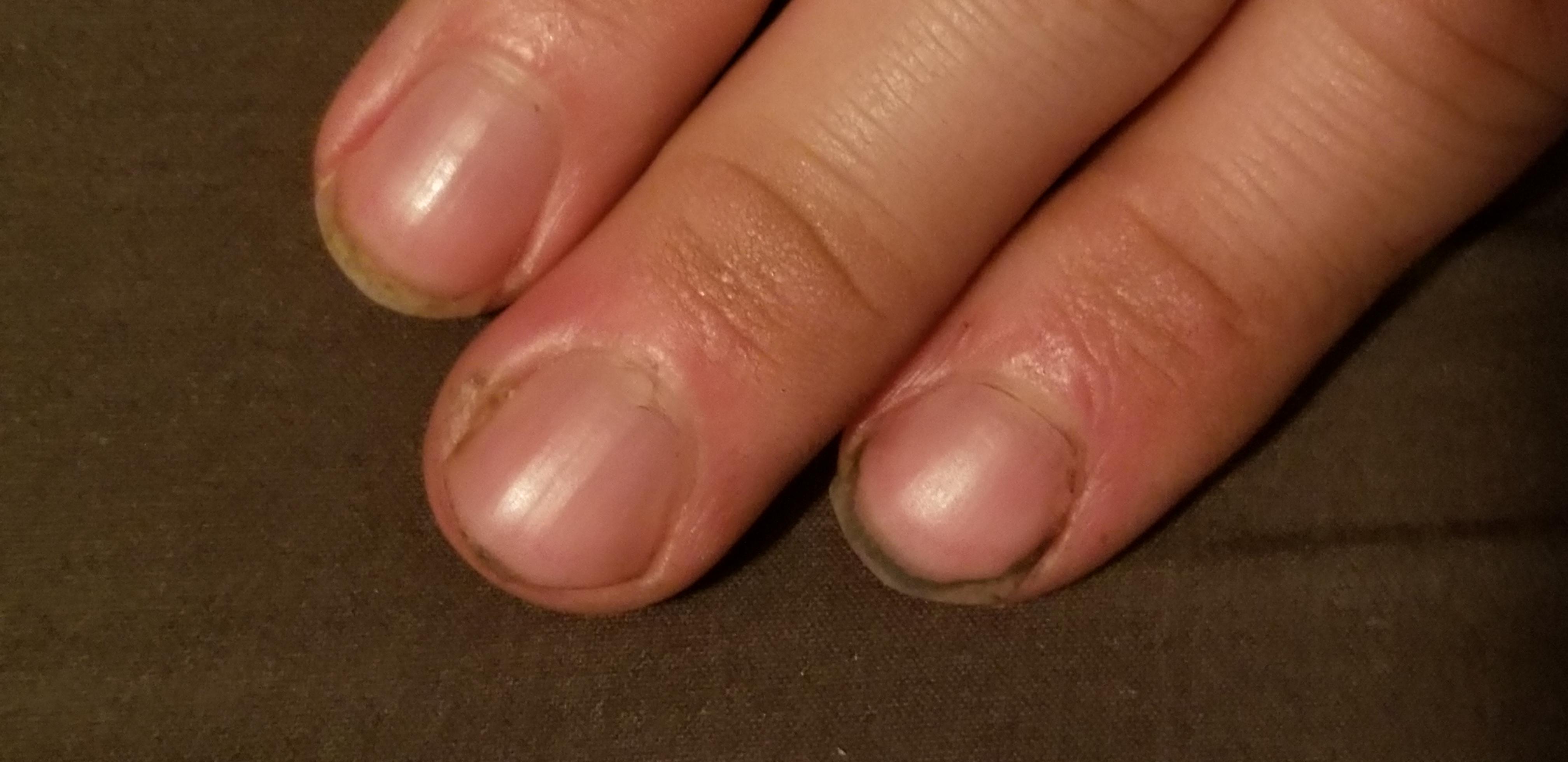 My finger hurts, right on the edge of the finger nail. Over the last