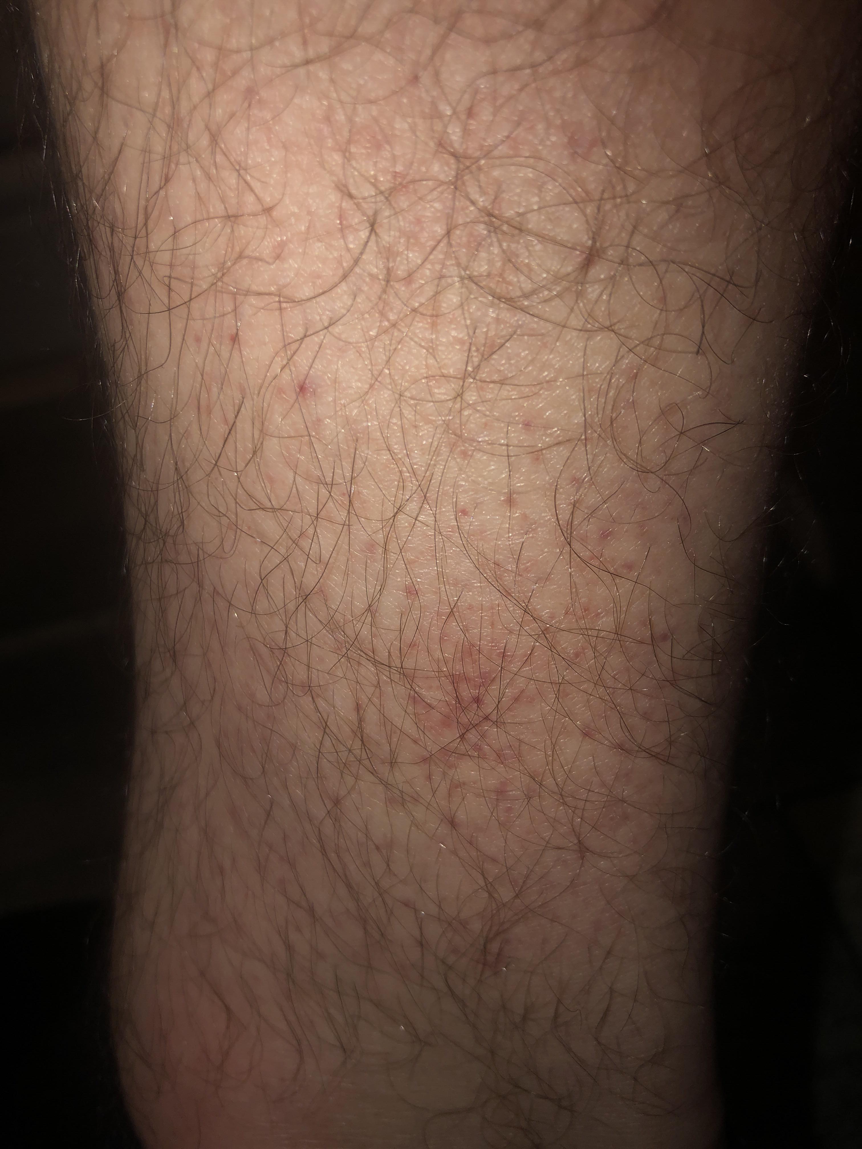 Petechiae? Ankles normal? r/leukemia