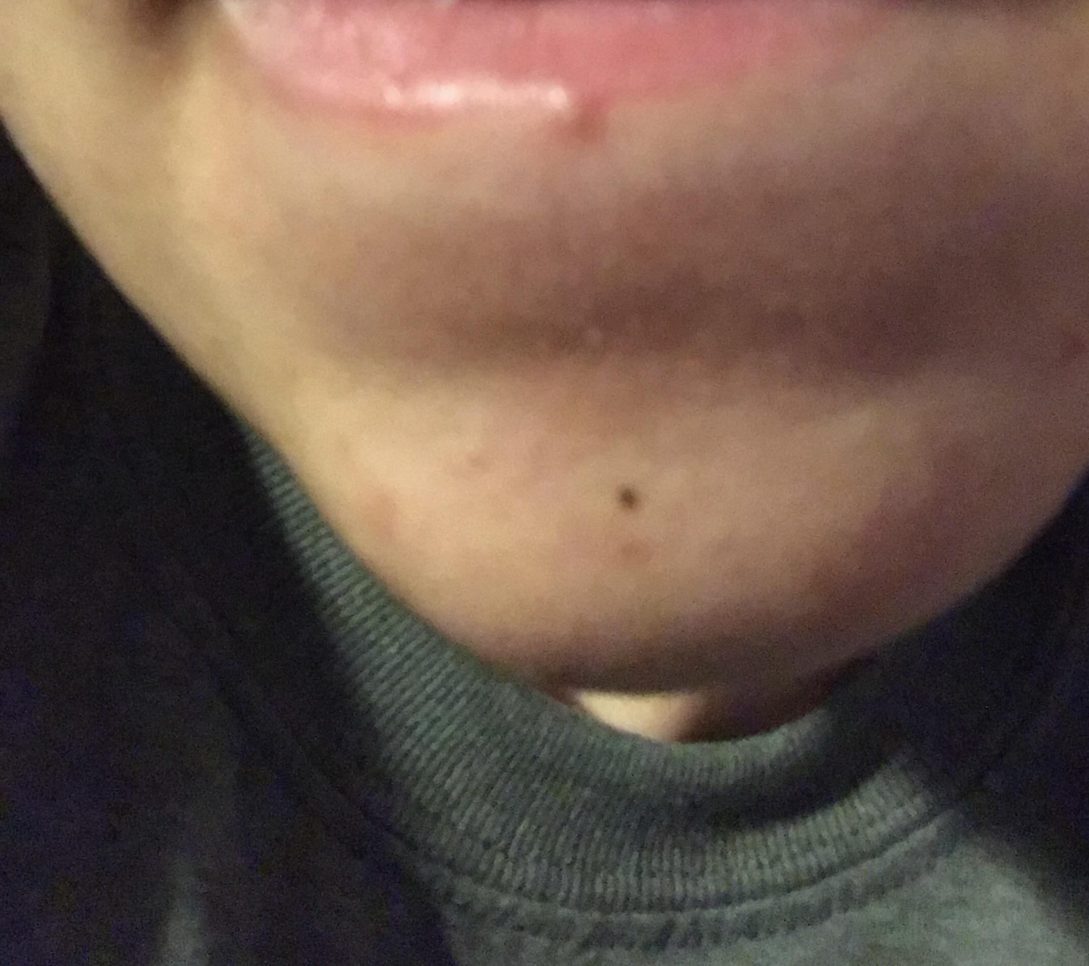 any tips on popping this? it’s been here for a few months now but