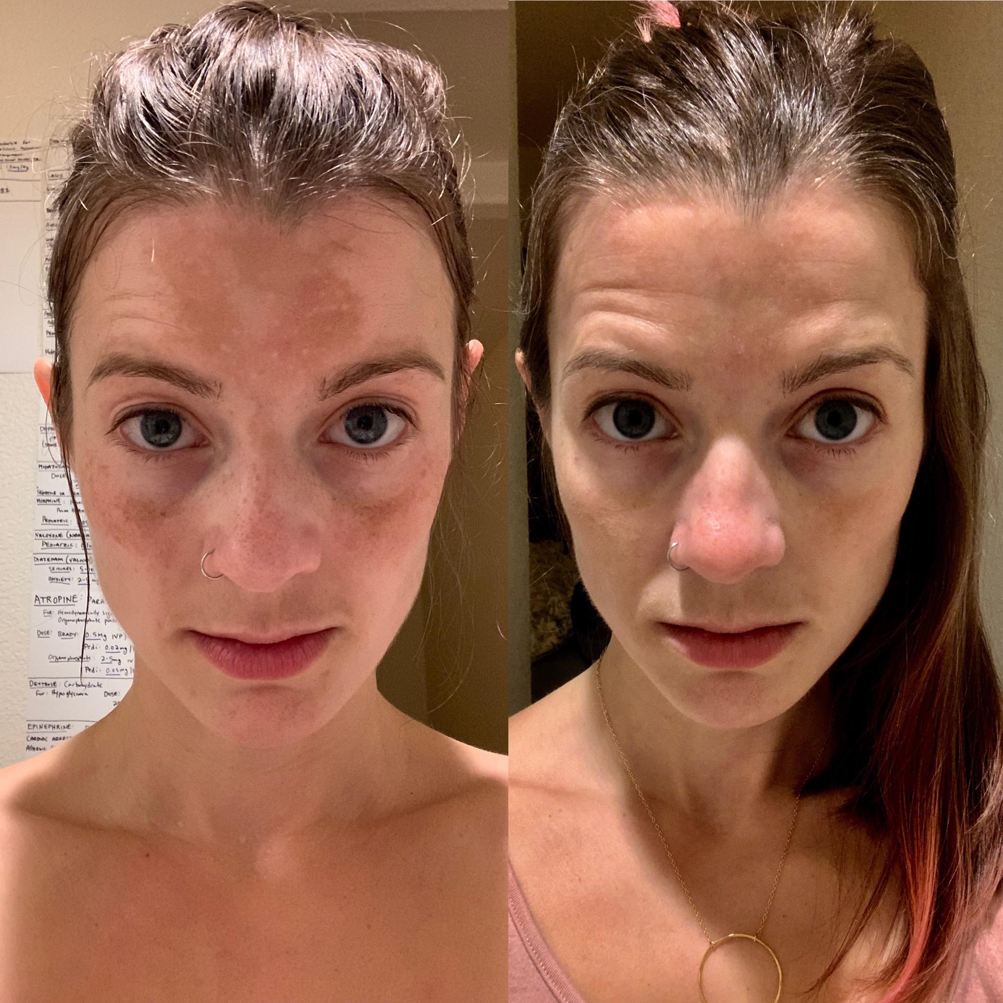 Melasma improvement 1 month with 2 hydroquinone every other night