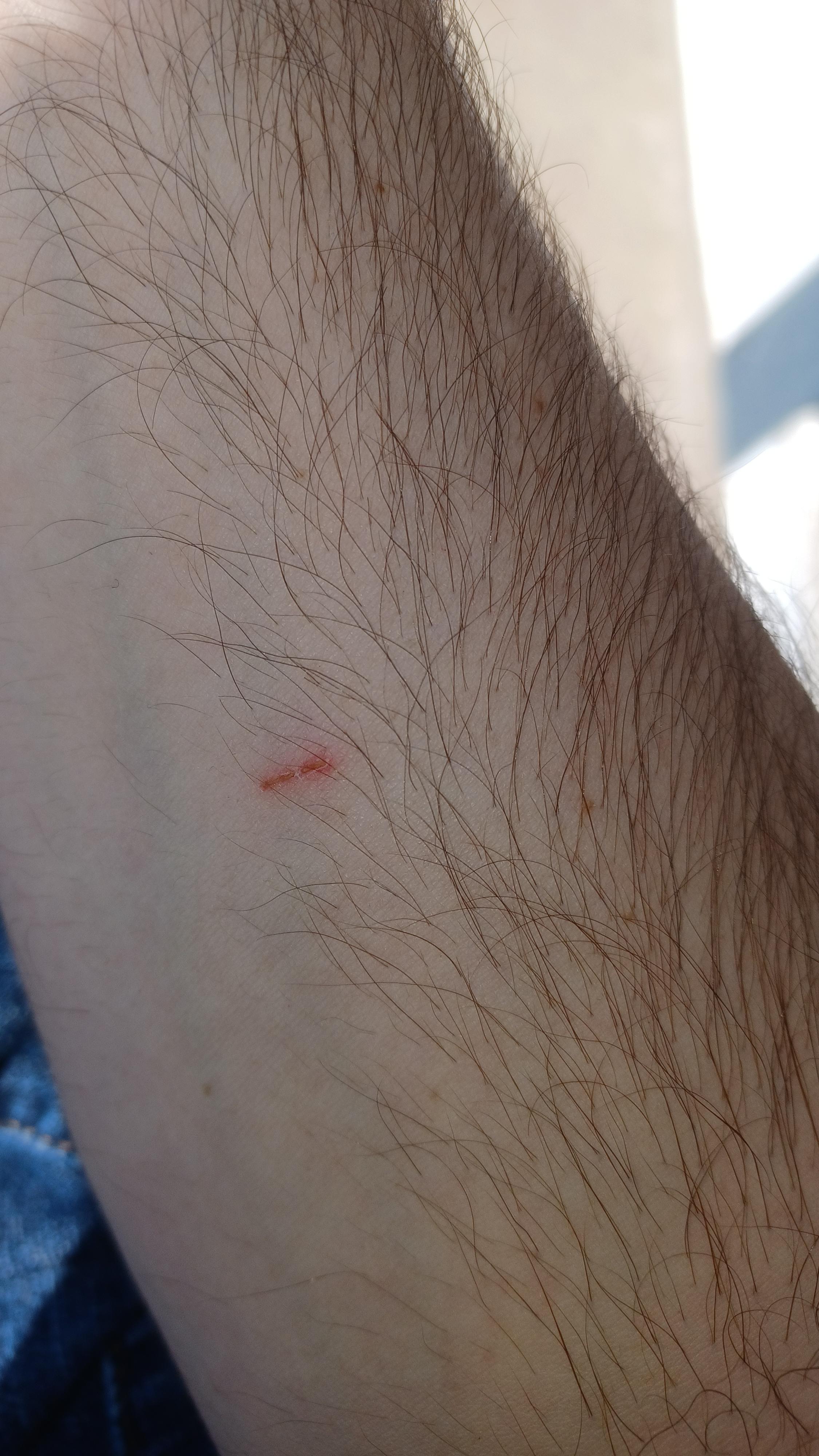 Found scratch on my arm last night. Is it a bat bite? Details in