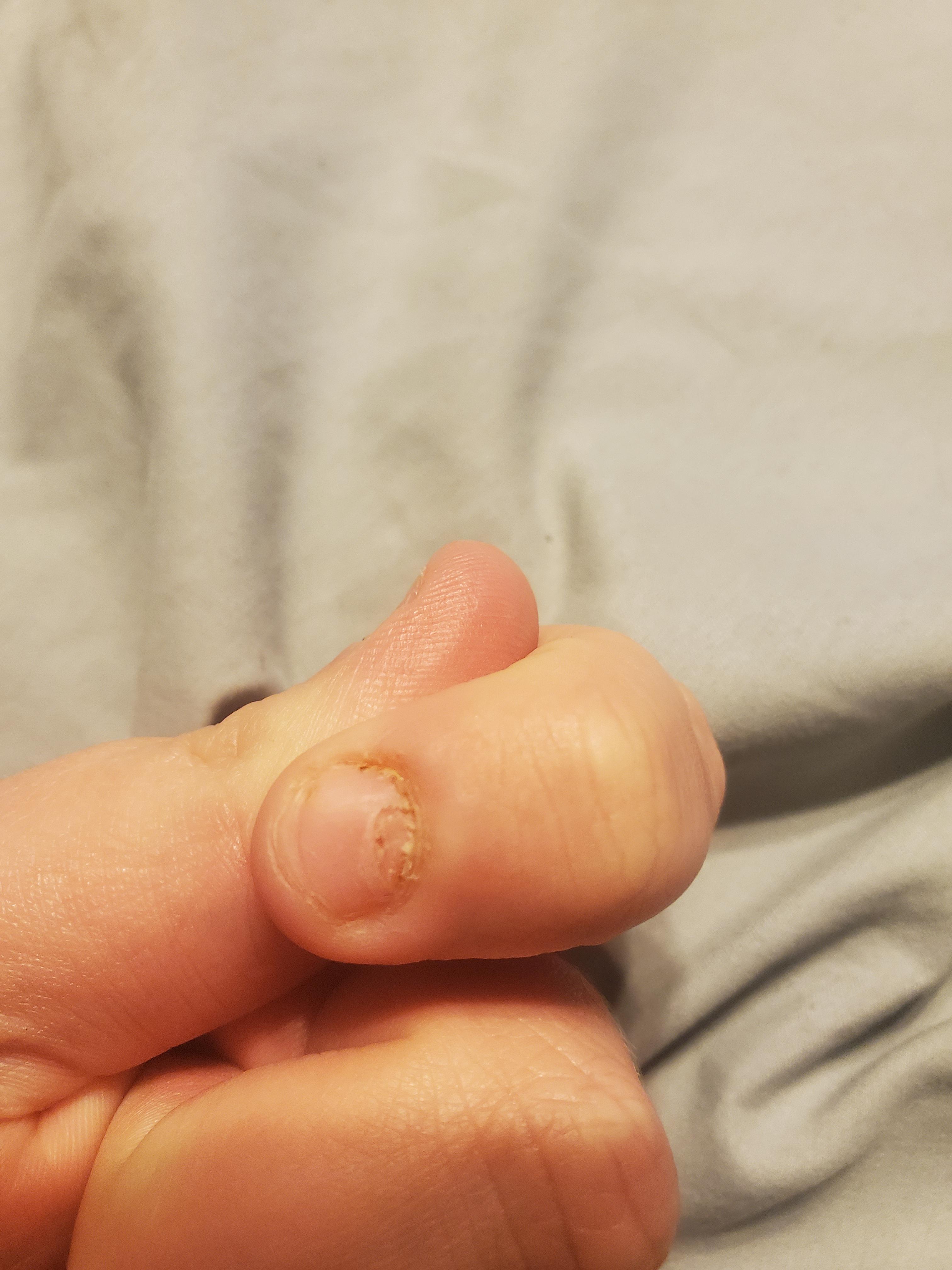 Will this hole in my nail prevent it from growing back? r/nailbiting