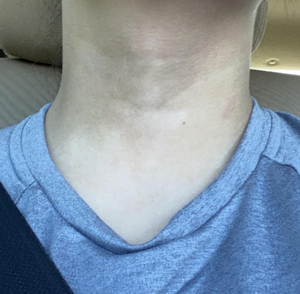Discoloration on neck? r/skin