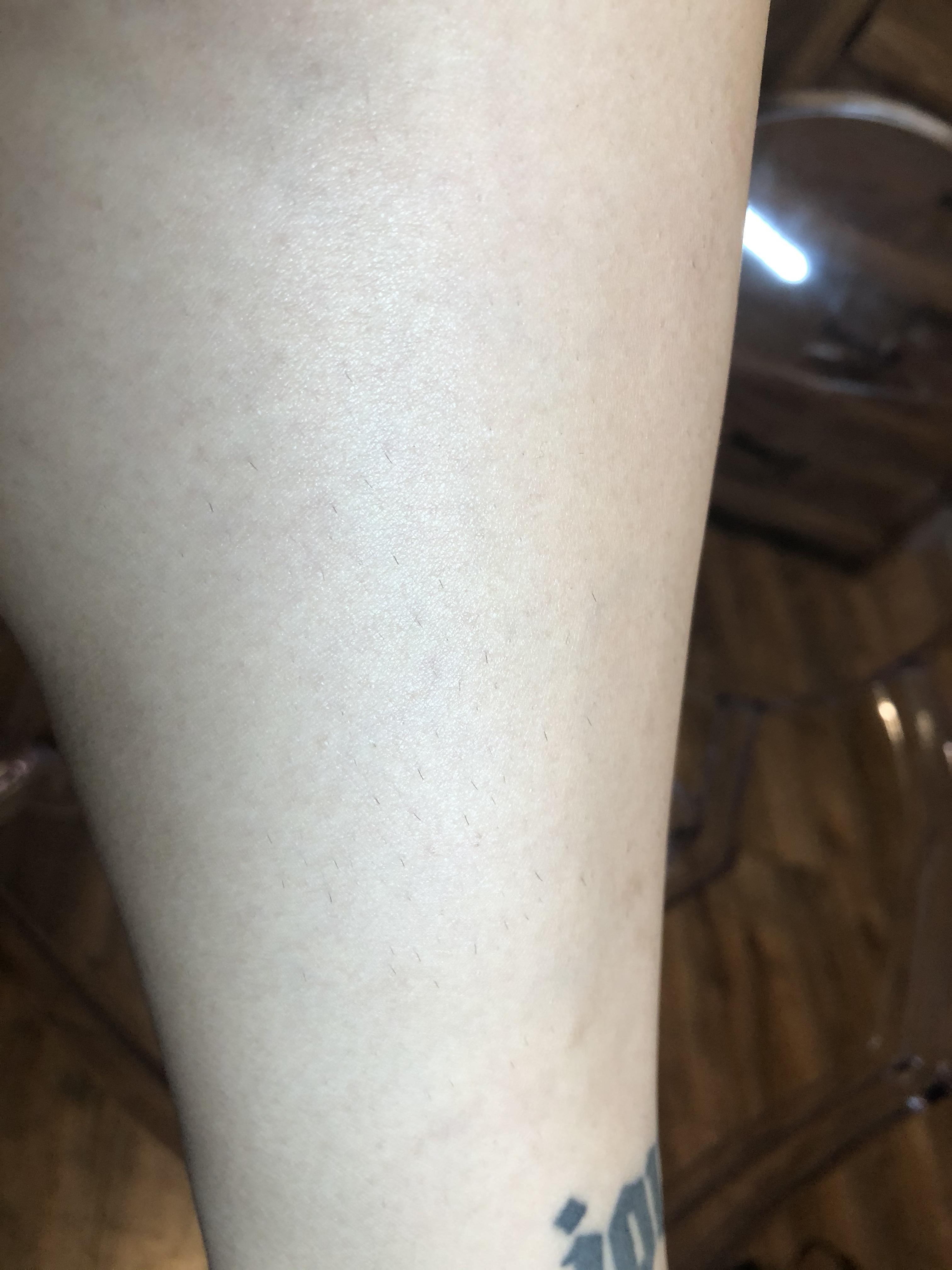 [hair removal] my results after 5 sessions of at home laser hair