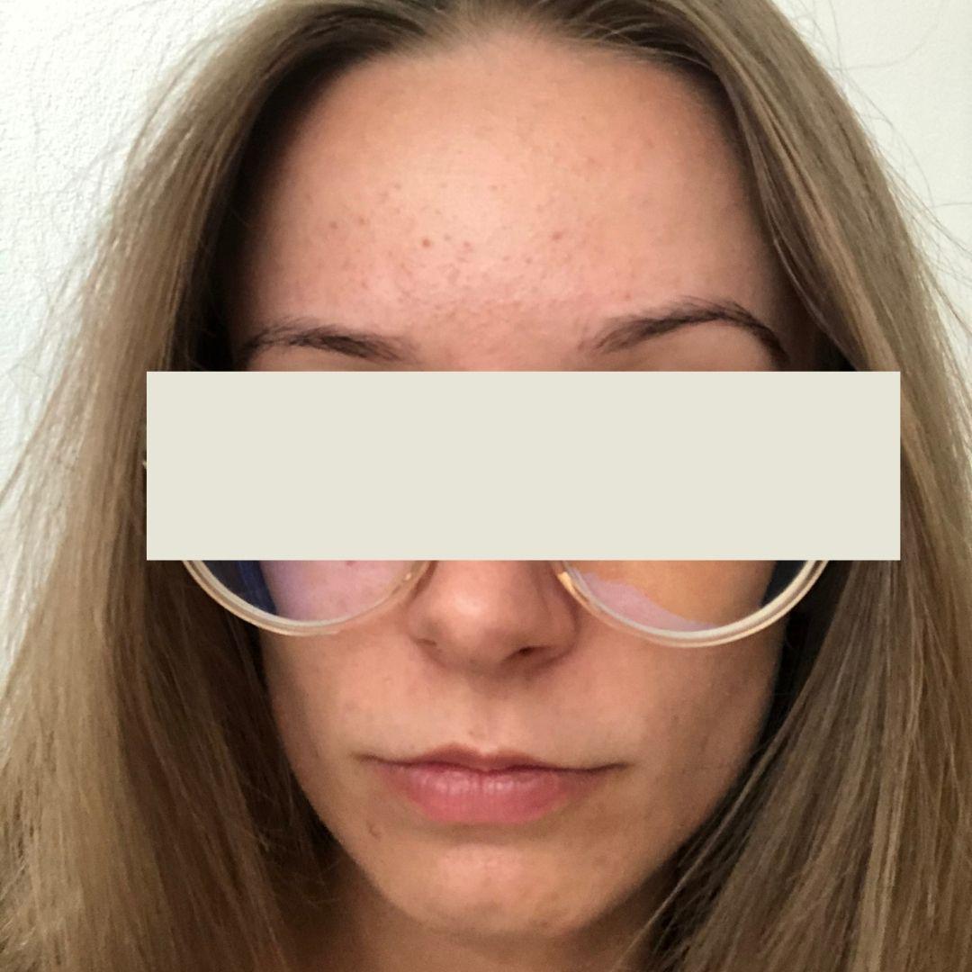 Fungal acne? Steroid induced rosacea? Both?? Fungalacne