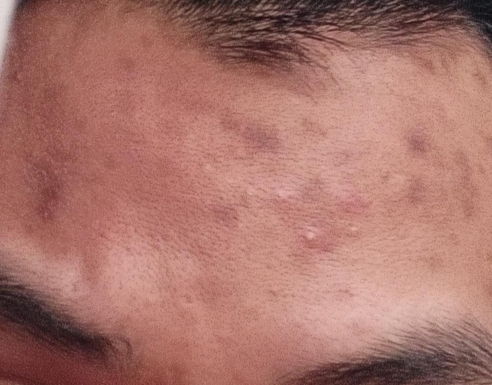 [Skin Concerns] Need Help. This is my forehead, as you can see i've