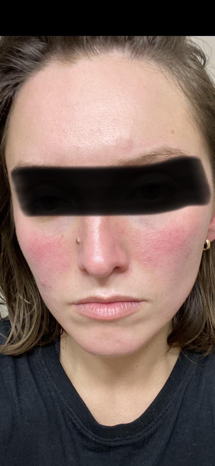 Any makeup for this kind of rosacea? r/Rosacea