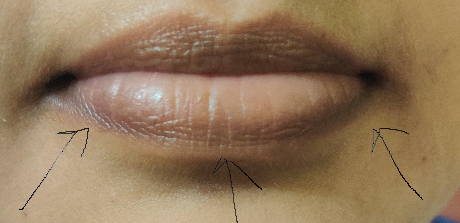 [Skin Concerns] I've had cracked lips and a dark outline under my lips