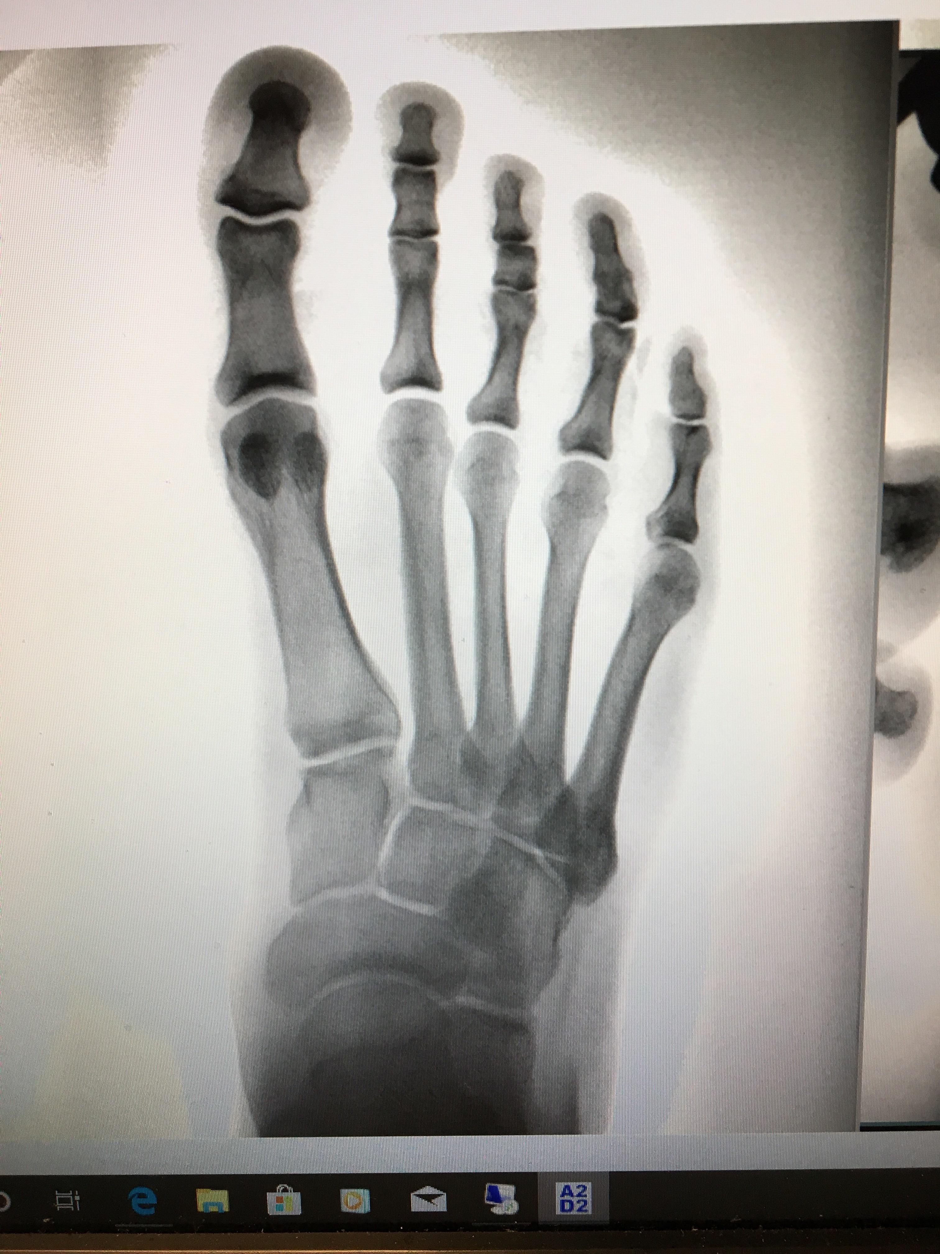 Midfoot smashed in door 2 months ago. Pain since, no relief. Do you see