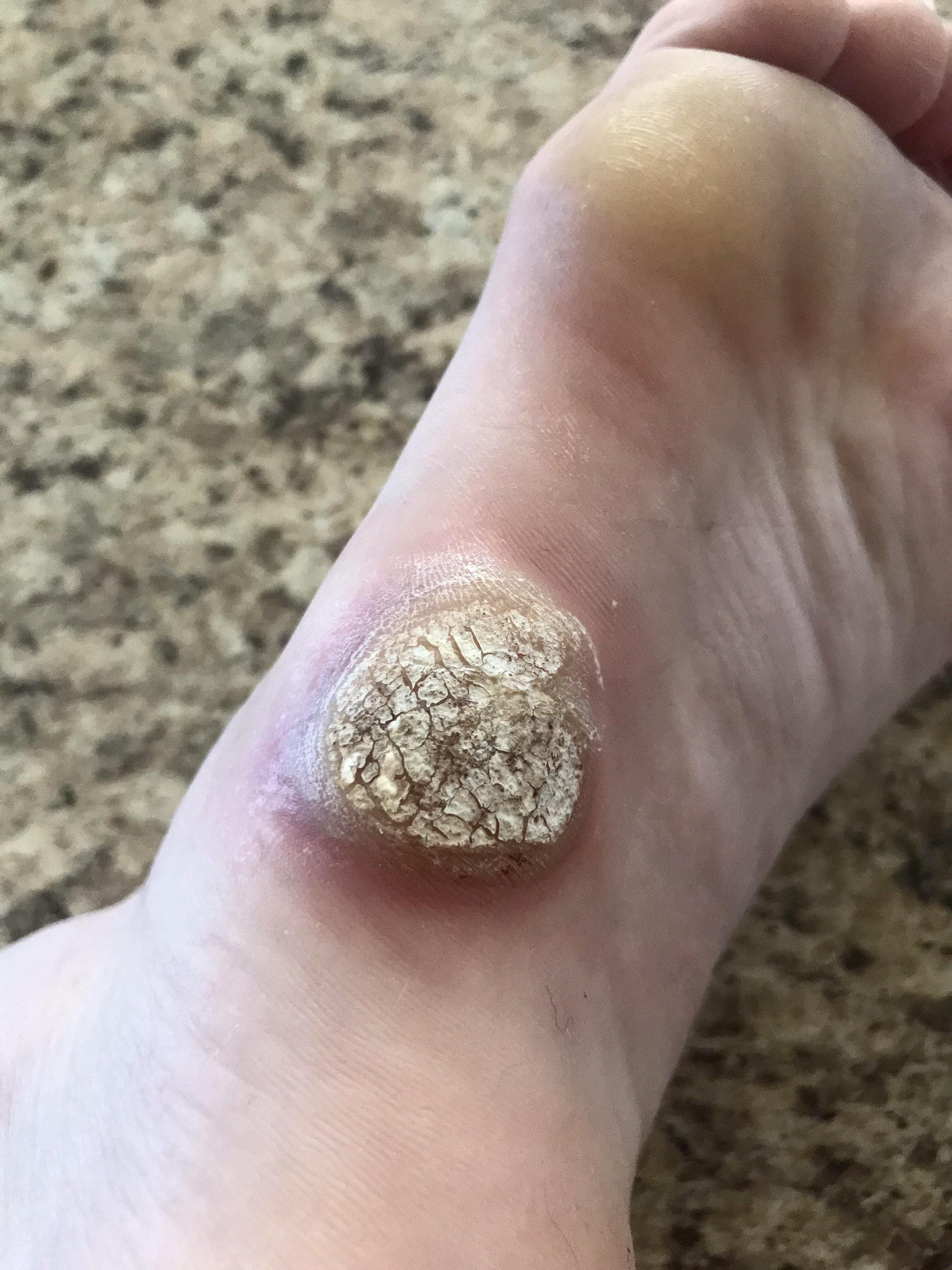 1123 best r/warts images on Pholder Gross warning. So I had my warts