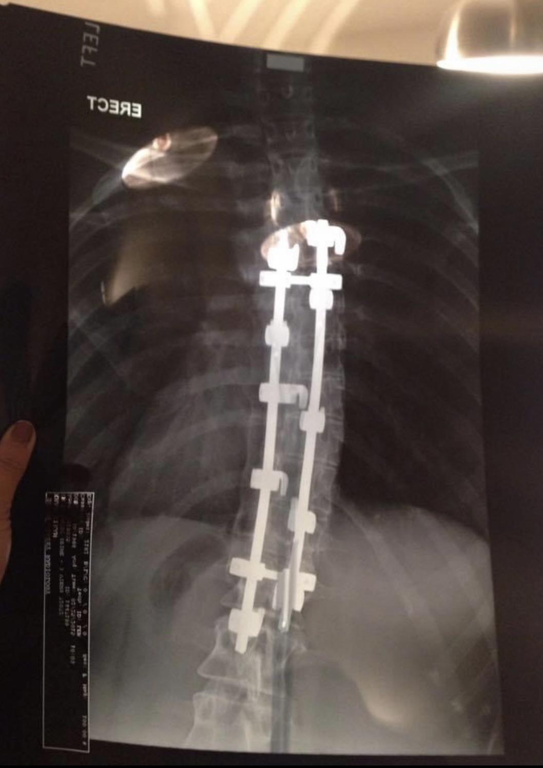 Harrington rods implanted 24 years ago r/scoliosis