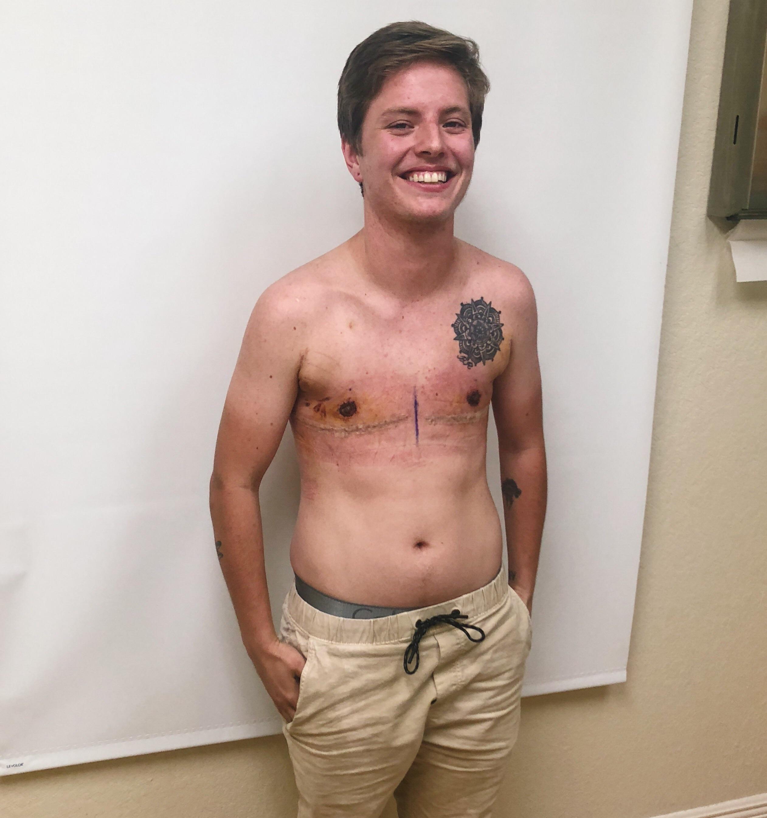 My boyfriend is 1 week post op today! (Top surgery) r/ftm