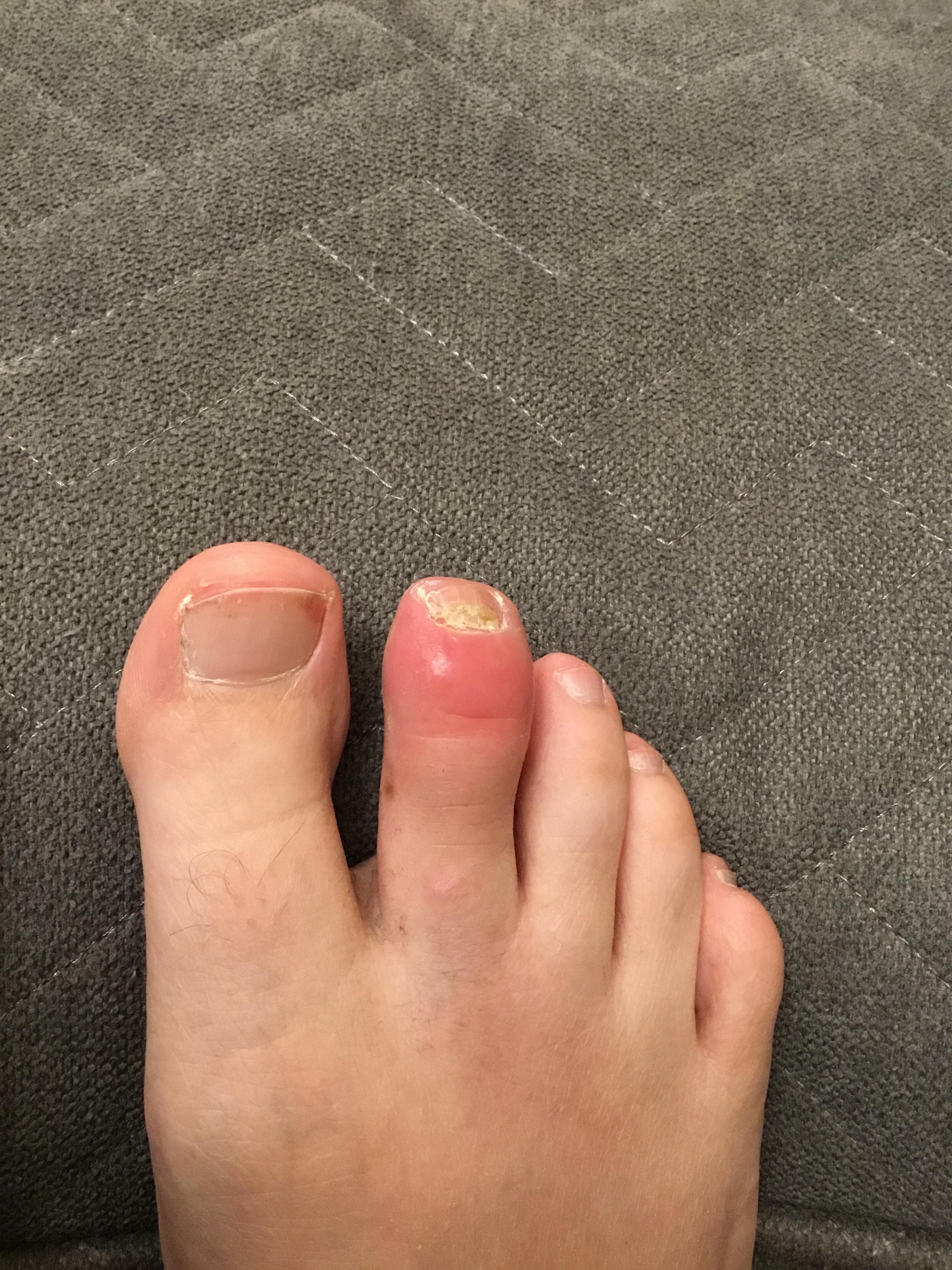 Psoriatic Arthritis Toes