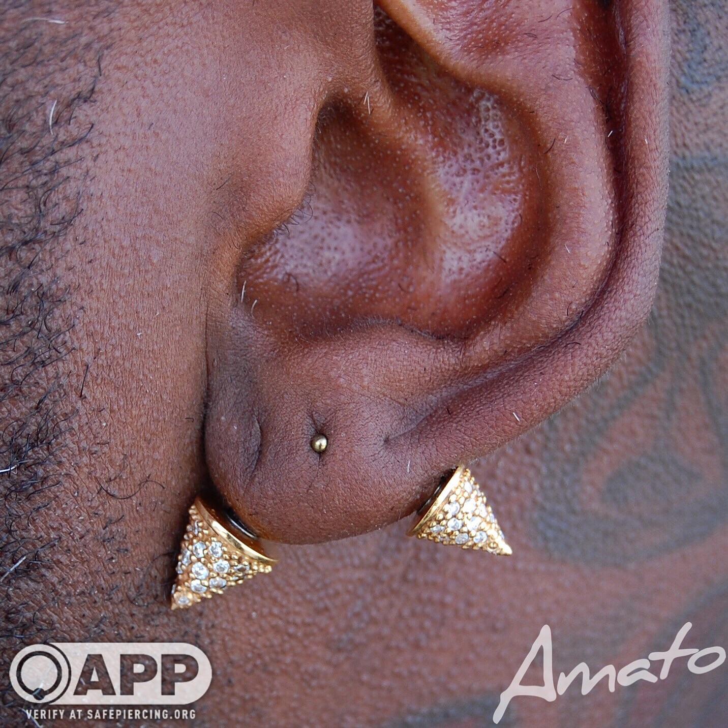 7 year healed transverse and healing high lobe above it, with custom