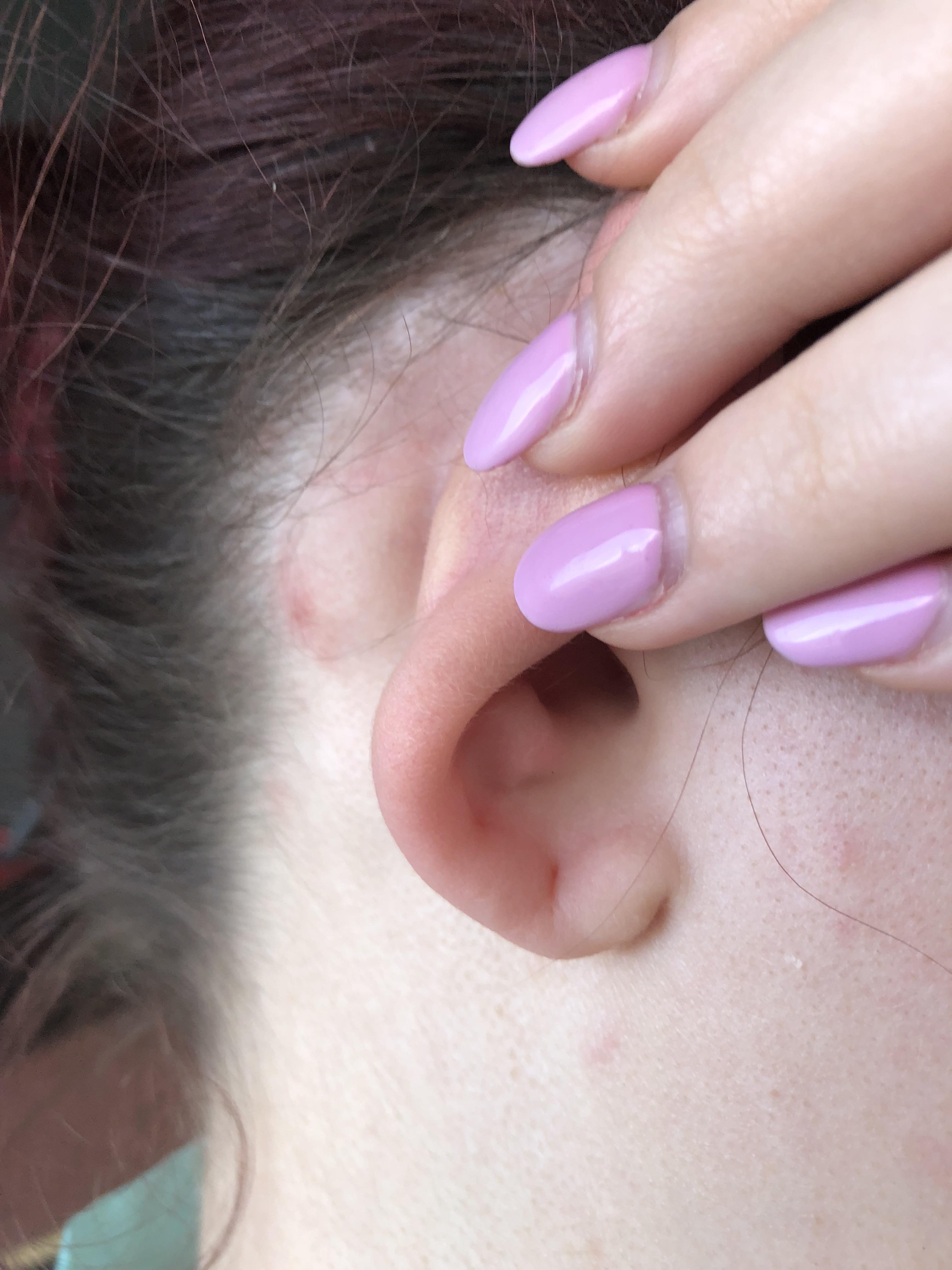 Woke up with this lump behind my ear, doctor said it was just my lymph nodes, but it hurts soo