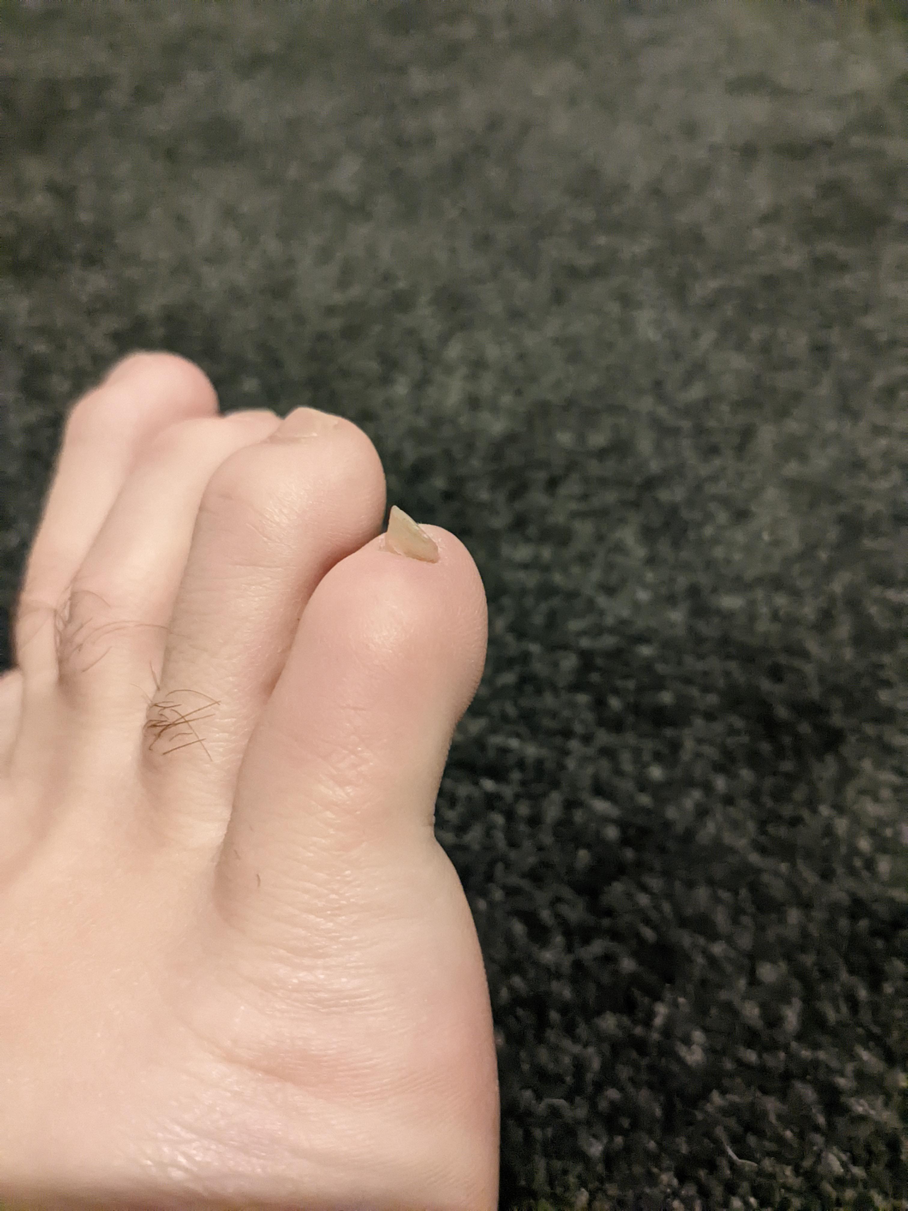 My pinky toe nail that grows at a complete 90 degree angle r