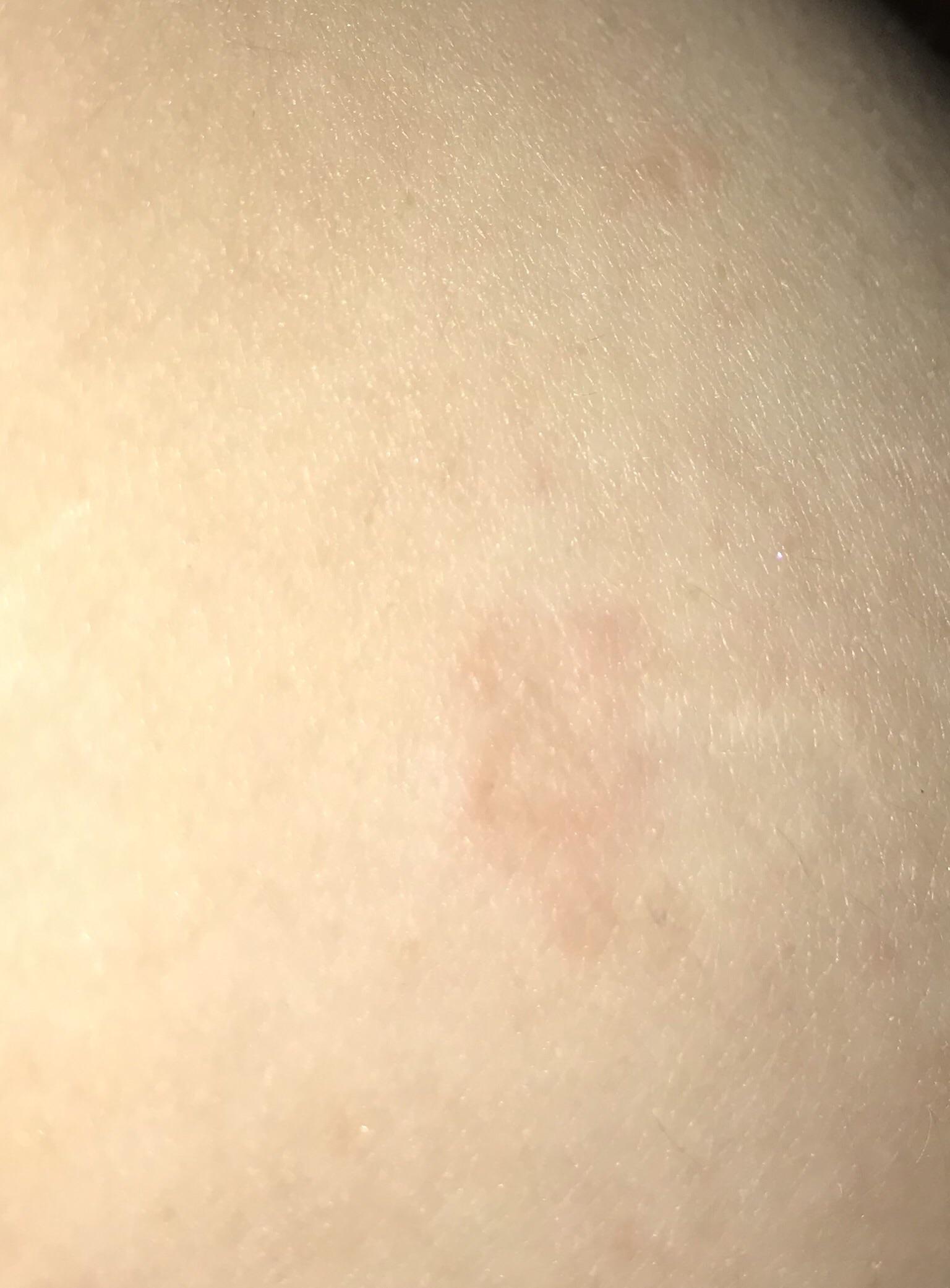 Is this eczema? It doesn’t itch or anything. I do get dry