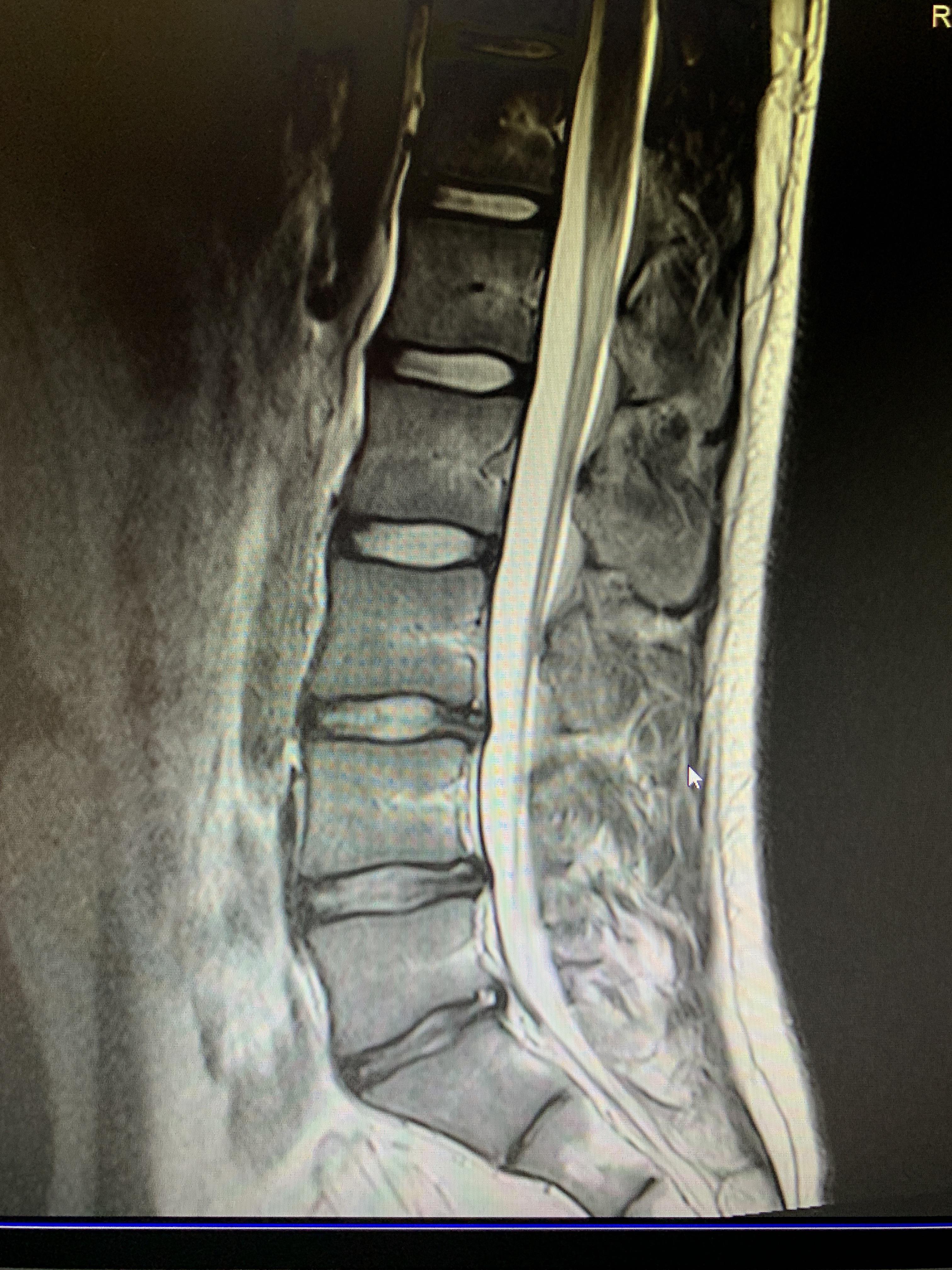 Have been having back pain for months and finally found out why