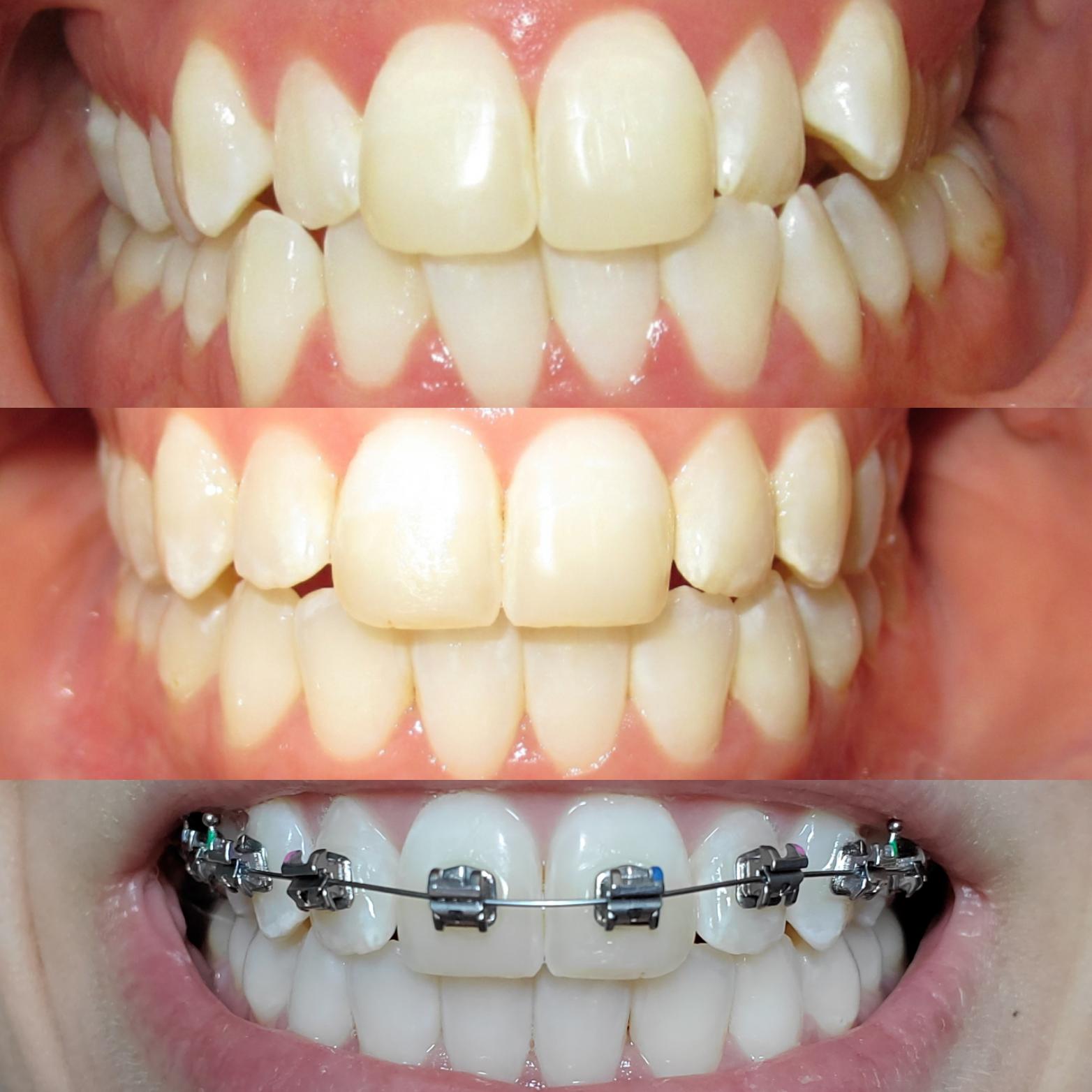 My progress so far! 1) Before treatment 2) 24 months into invisalign 3) First day switched in