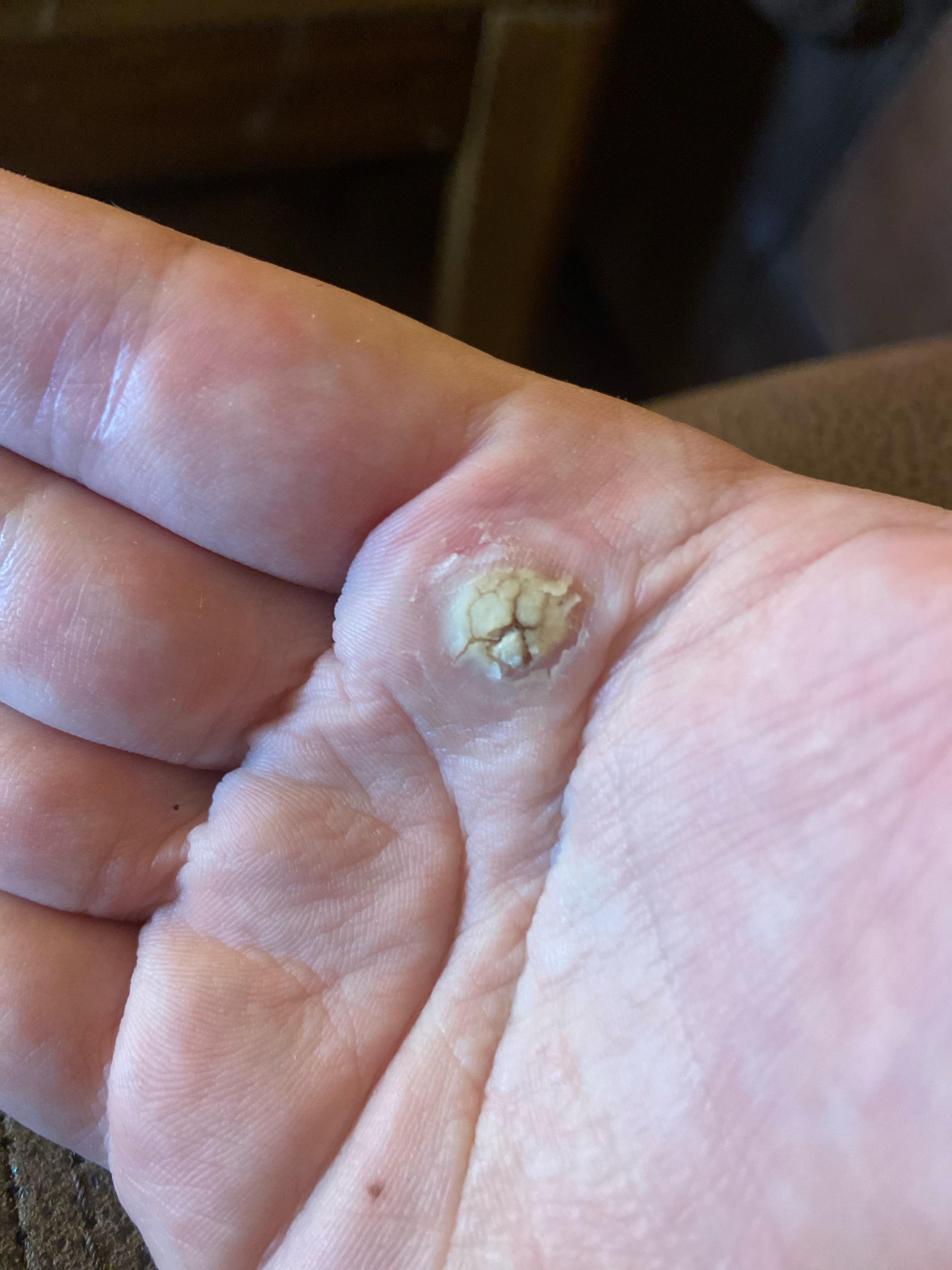 3 year wart, numerous trips to the dermatologist to freeze it/salicylic