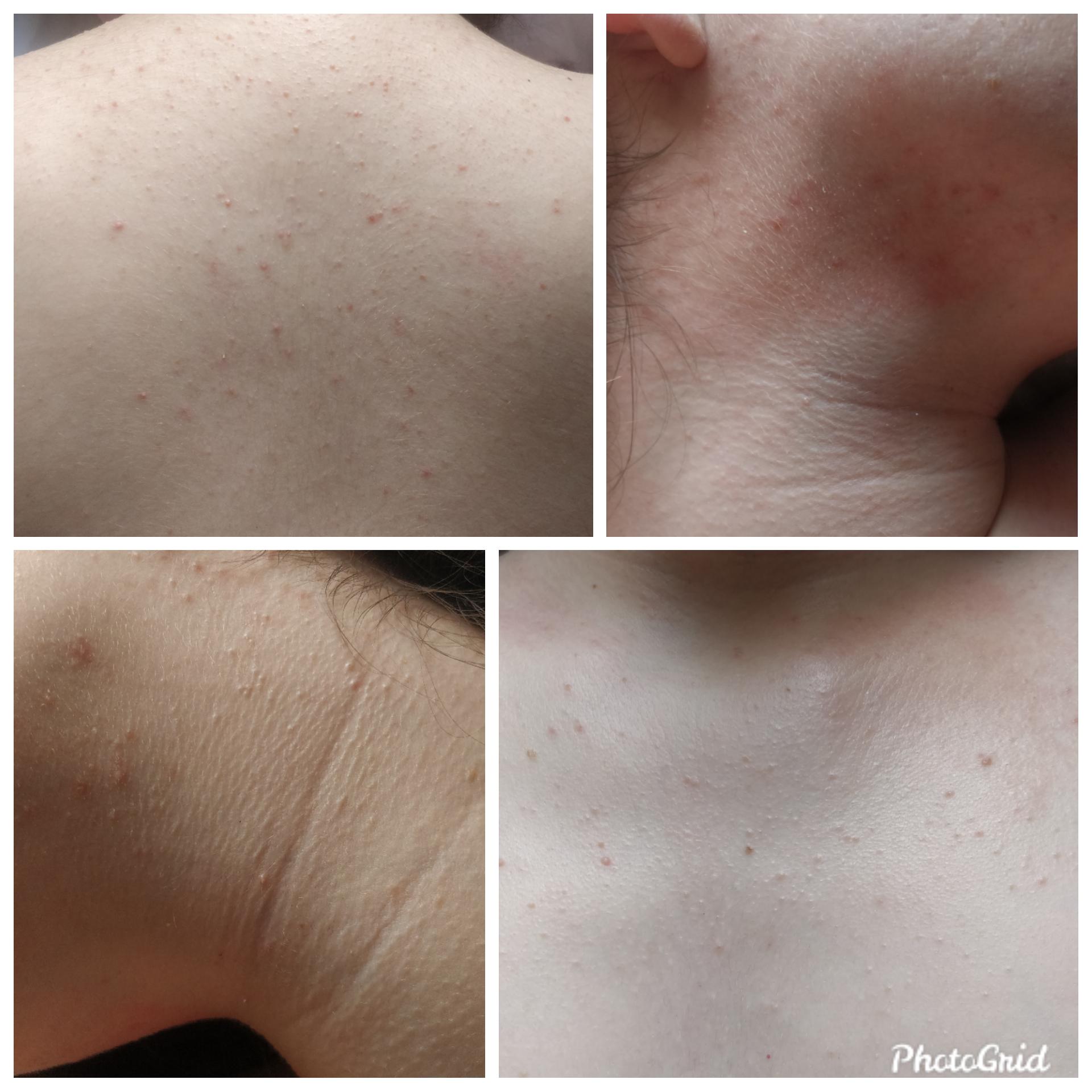 [Skin Concerns] A lot of itching little pimples appeared on chest/back
