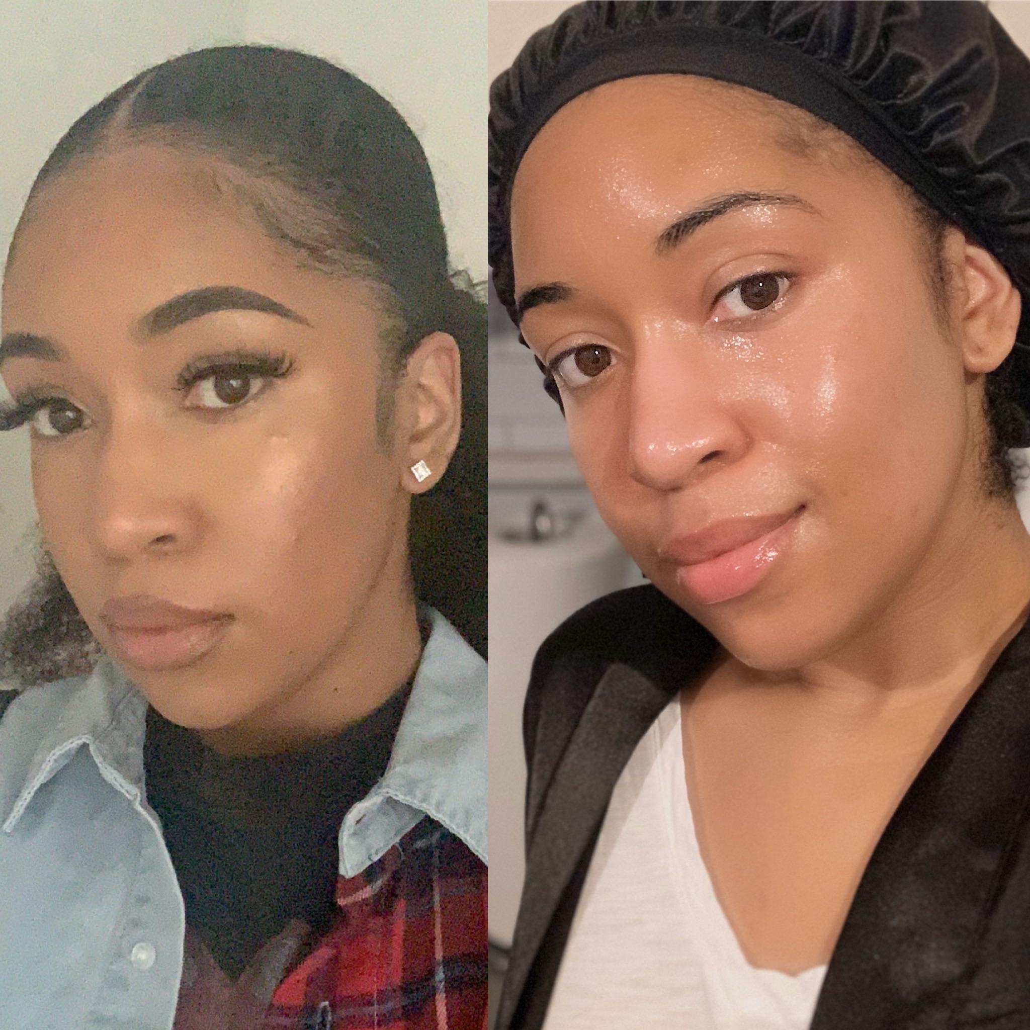 [Selfie/B&A] Finally close to having the glass skin of my dreams!! r