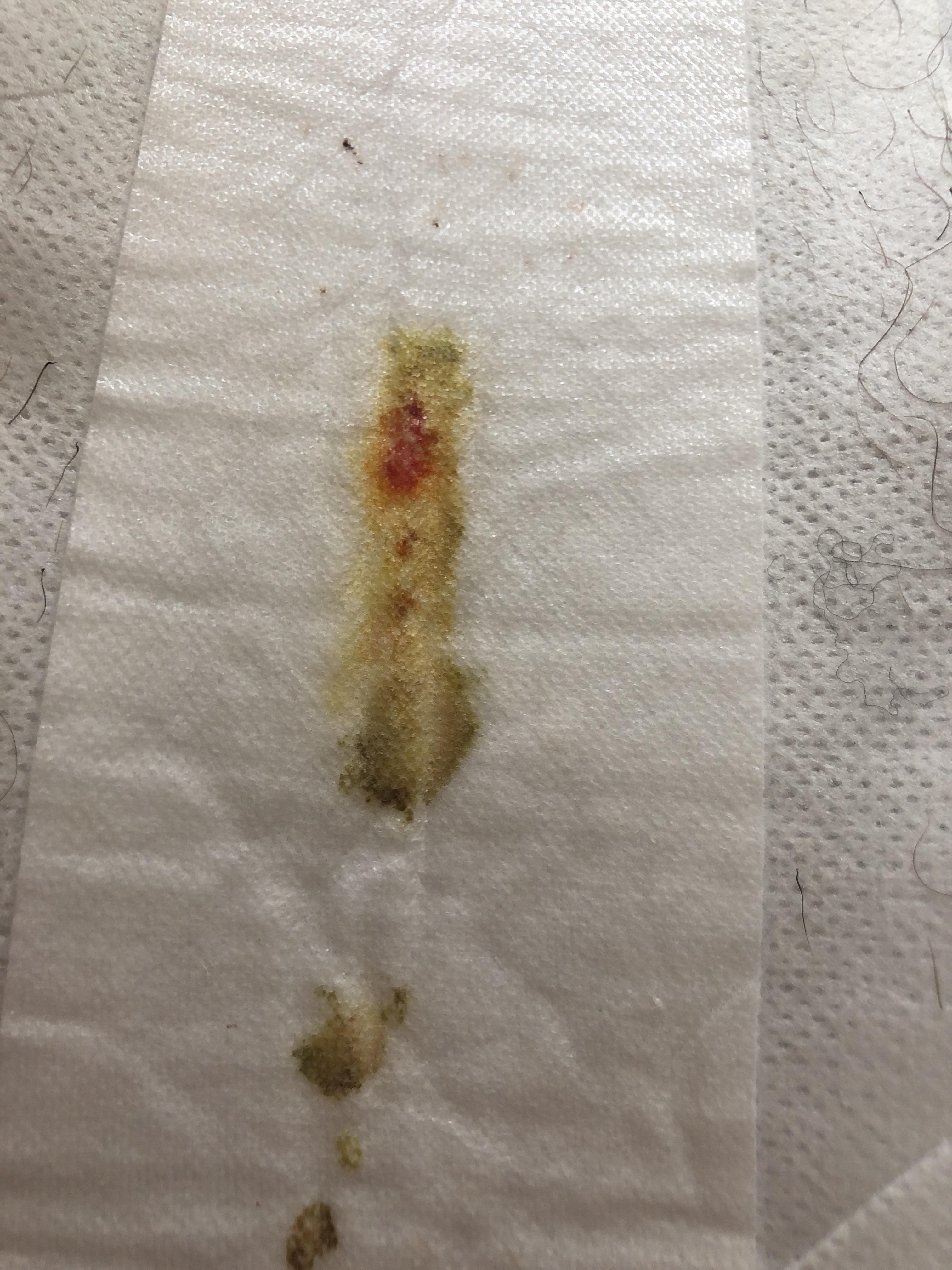 Is this normal wound drainage? r/medical