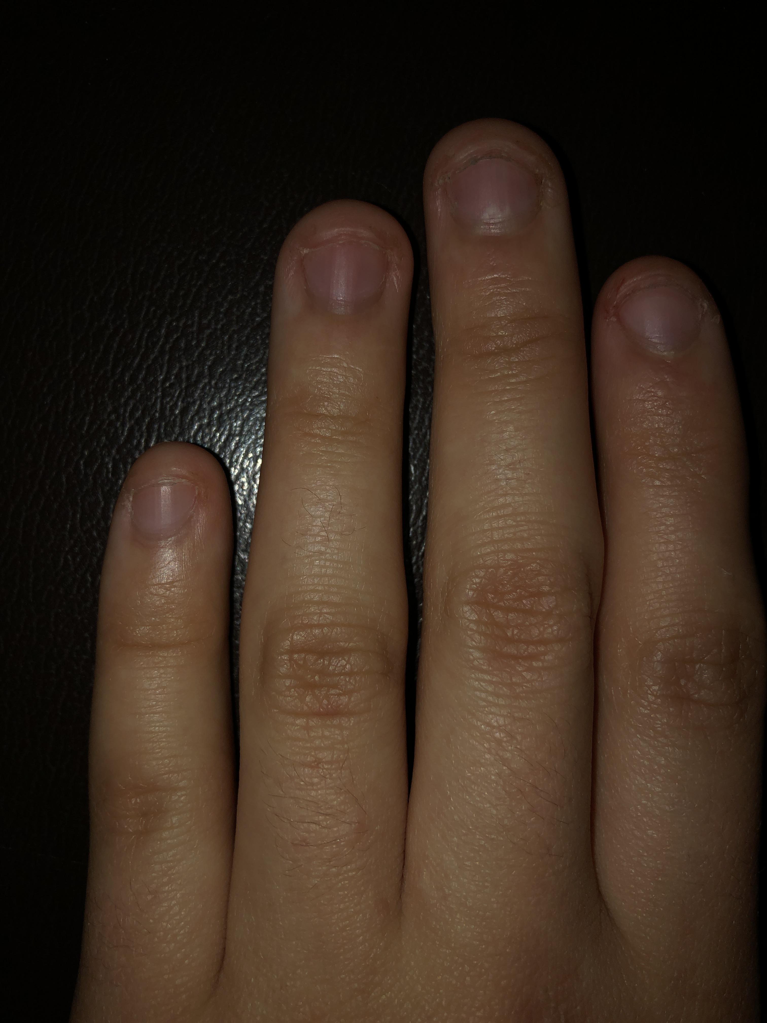 If my nails get longer would they ever look normal? Is it possible to bite them for so long that